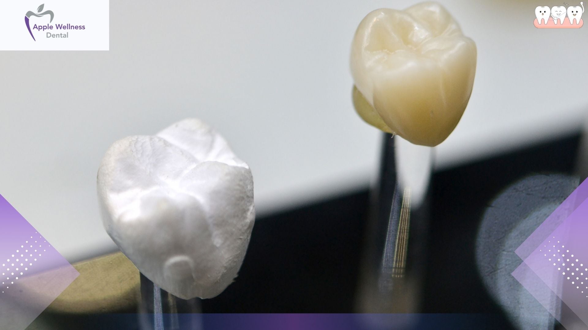 The Complete Guide to Provisional Dental Restorations: Purpose, Process, and Care - Apple Wellness Dental The Complete Guide to Provisional Dental Restorations: Purpose, Process, and Care - Apple Wellness Dental