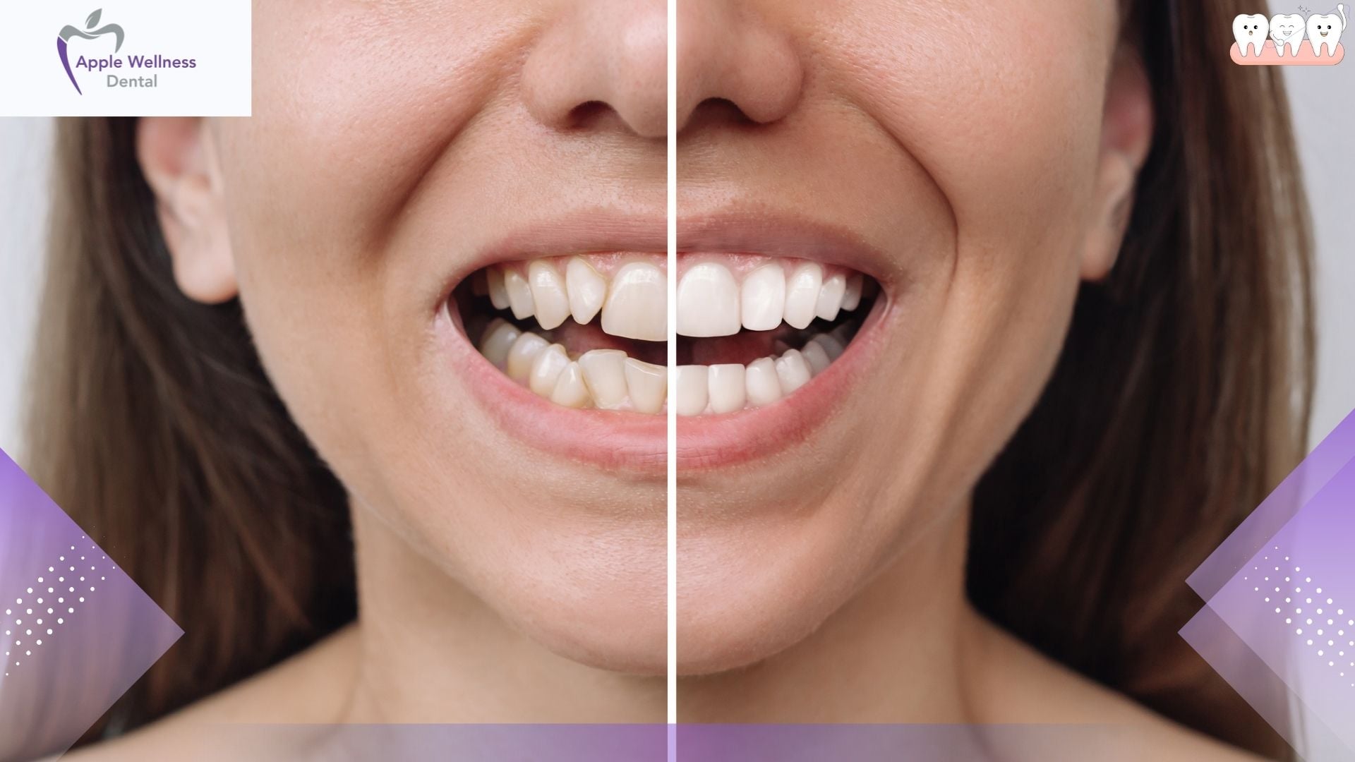 How to Correct an Uneven Smile: A Complete Guide to Facial Asymmetry - Apple Wellness Dental How to Correct an Uneven Smile: A Complete Guide to Facial Asymmetry - Apple Wellness Dental