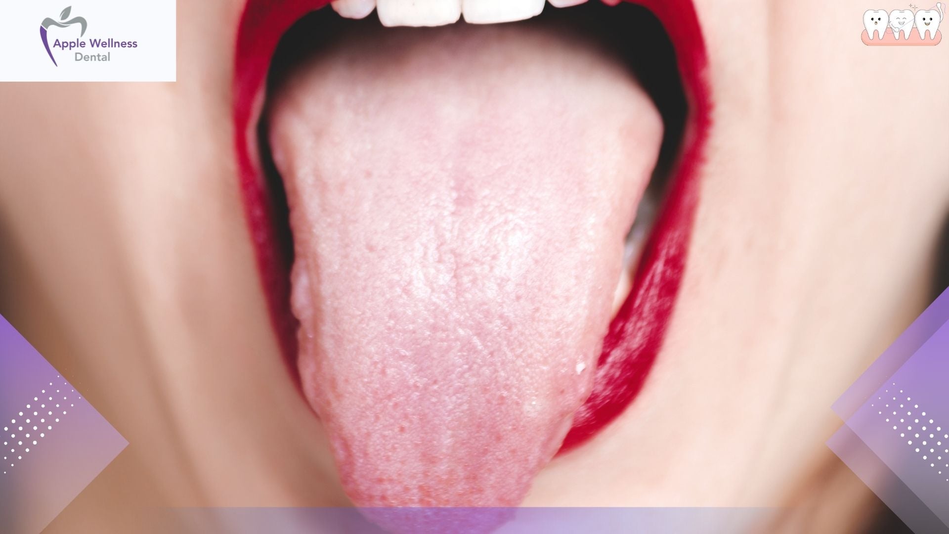 Understanding Xerostomia: Causes, Symptoms, and Effective Treatments - Apple Wellness Dental