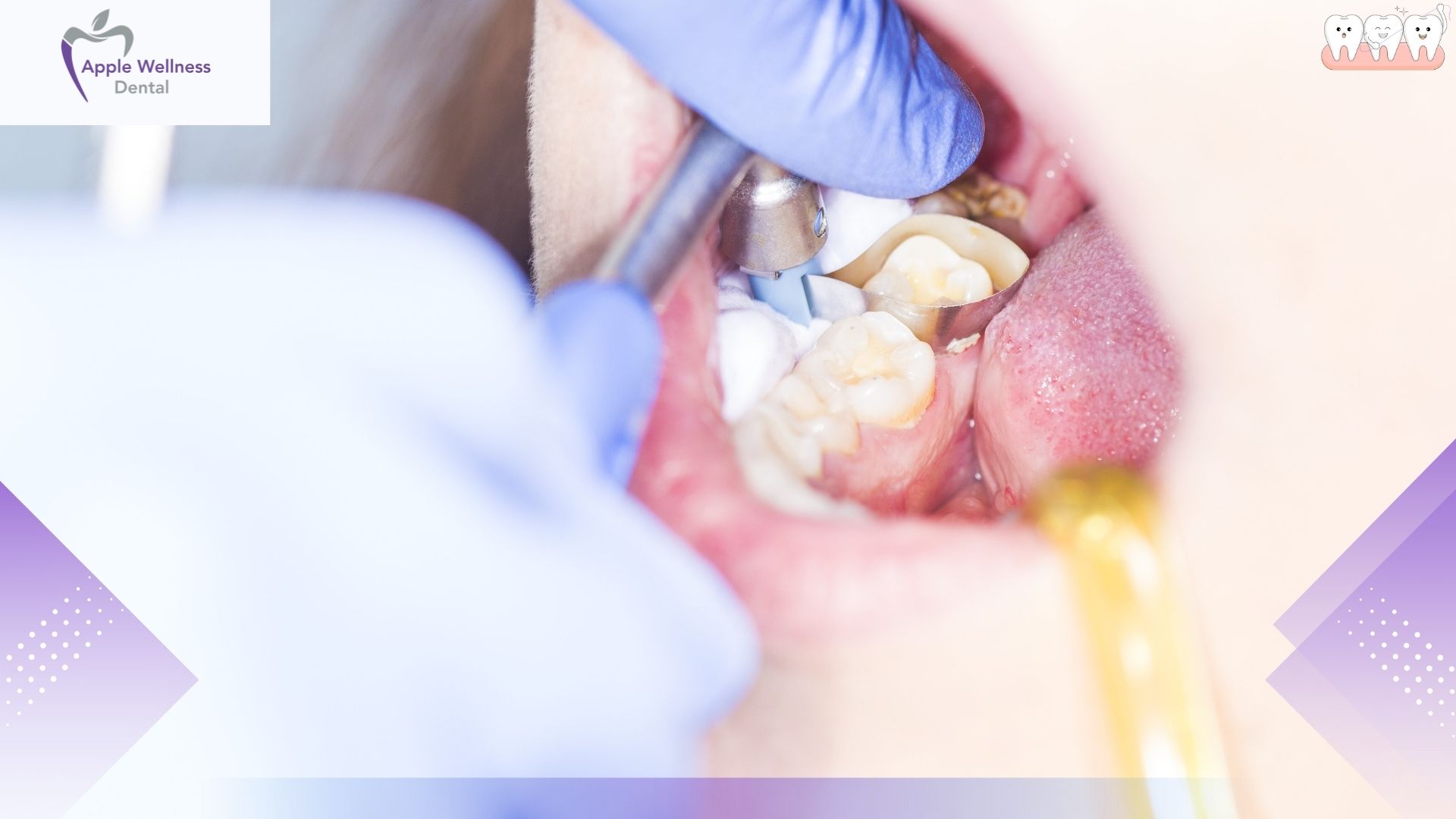 Cosmetic Dentistry in Airdrie, AB: Smile Transformation at Apple Wellness Dental - Apple Wellness Dental