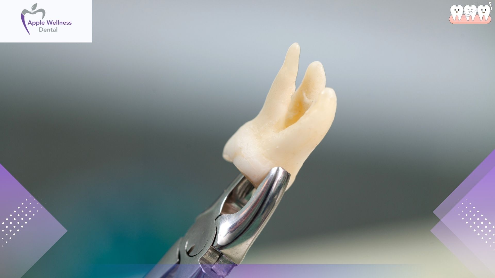 Tooth Extraction in Airdrie, Alberta: Safe, Gentle, Expert Care at Apple Wellness Dental - Apple Wellness Dental