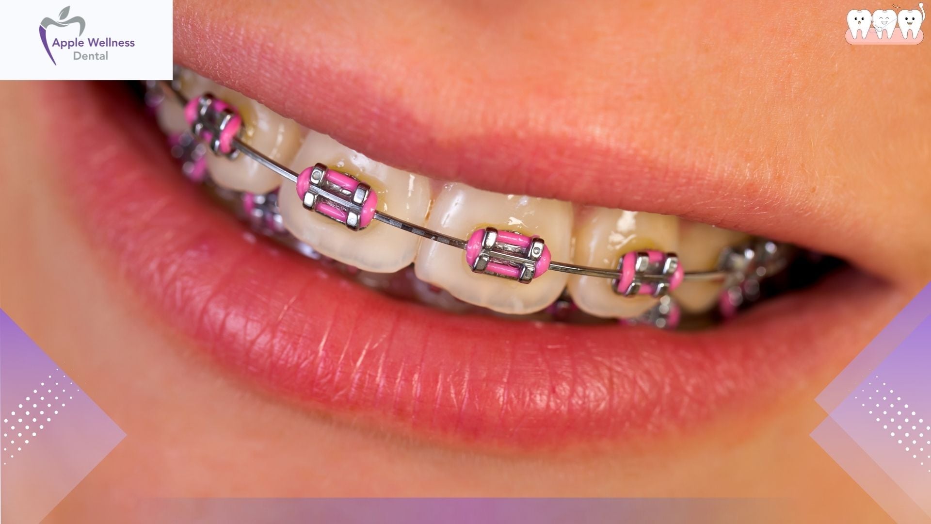 The Complete Guide to Keeping Teeth and Gums Healthy During Orthodontic Treatment - Apple Wellness Dental