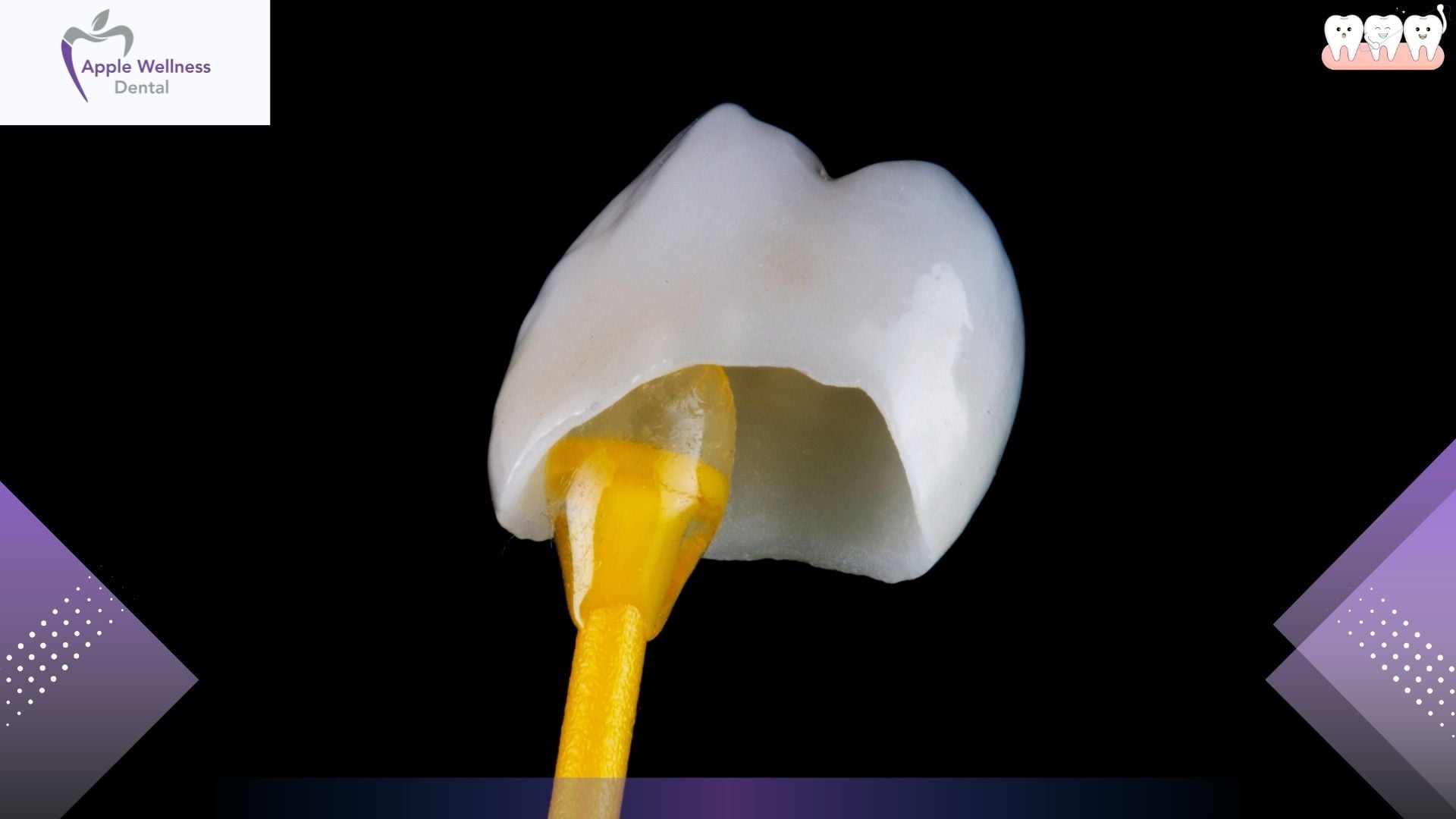 The Complete Guide to Provisional Dental Restorations: Purpose, Process, and Care - Apple Wellness Dental The Complete Guide to Provisional Dental Restorations: Purpose, Process, and Care - Apple Wellness Dental