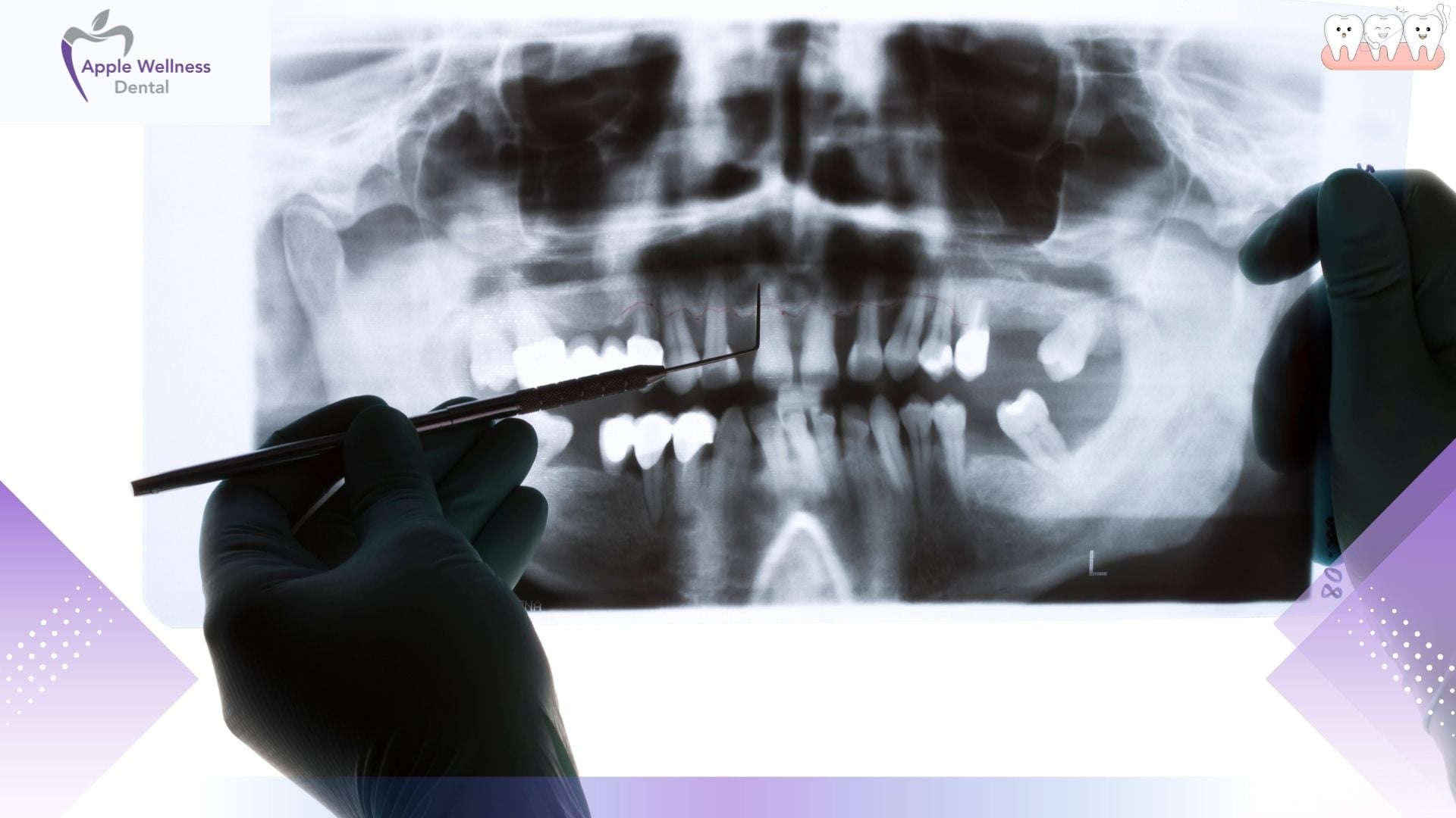The Complete Guide to Dental Radiography: How X-Rays Protect Your Smile - Apple Wellness Dental
