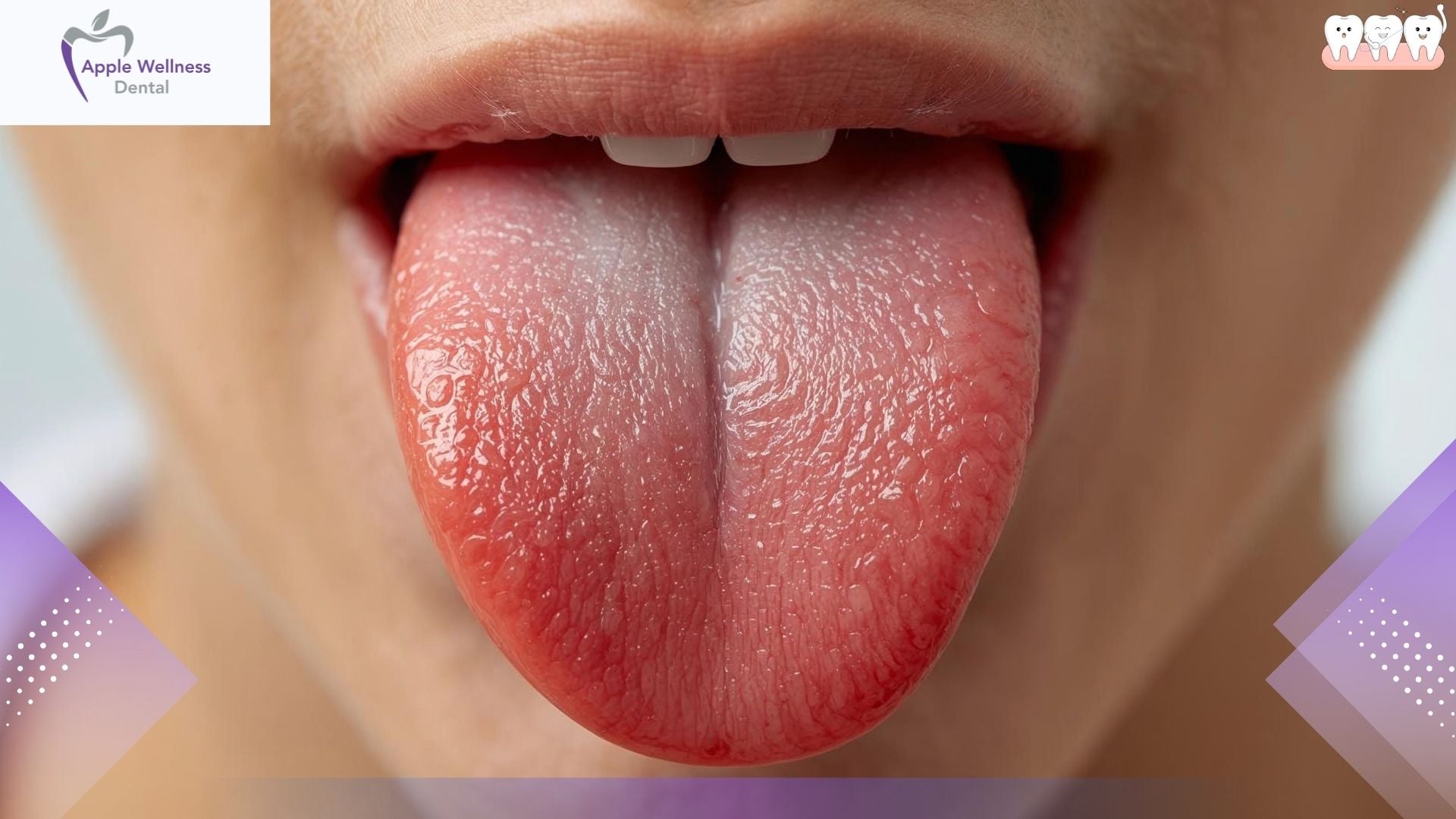 Understanding Xerostomia: Causes, Symptoms, and Effective Treatments - Apple Wellness Dental