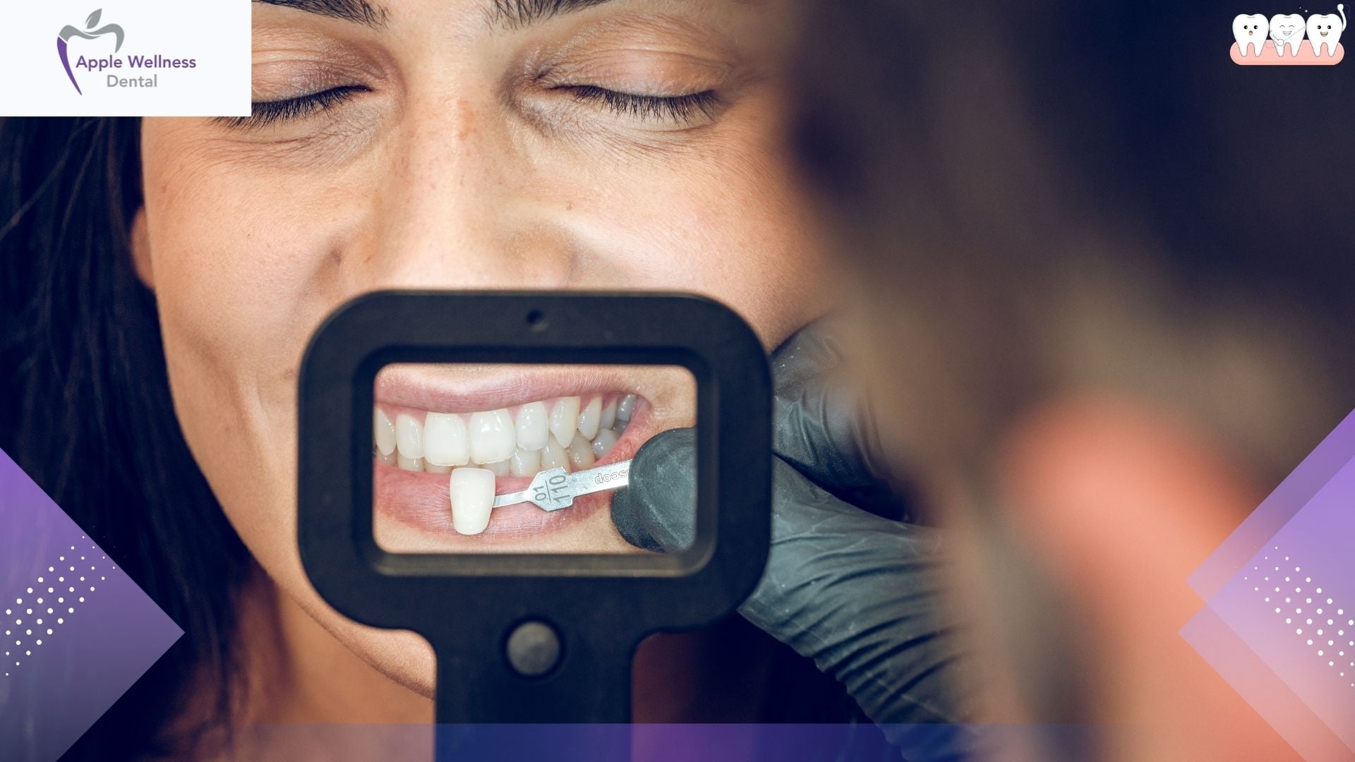 Are Veneers Expensive? A Straightforward Breakdown of What Drives the Price - Apple Wellness Dental Are Veneers Expensive? A Straightforward Breakdown of What Drives the Price - Apple Wellness Dental