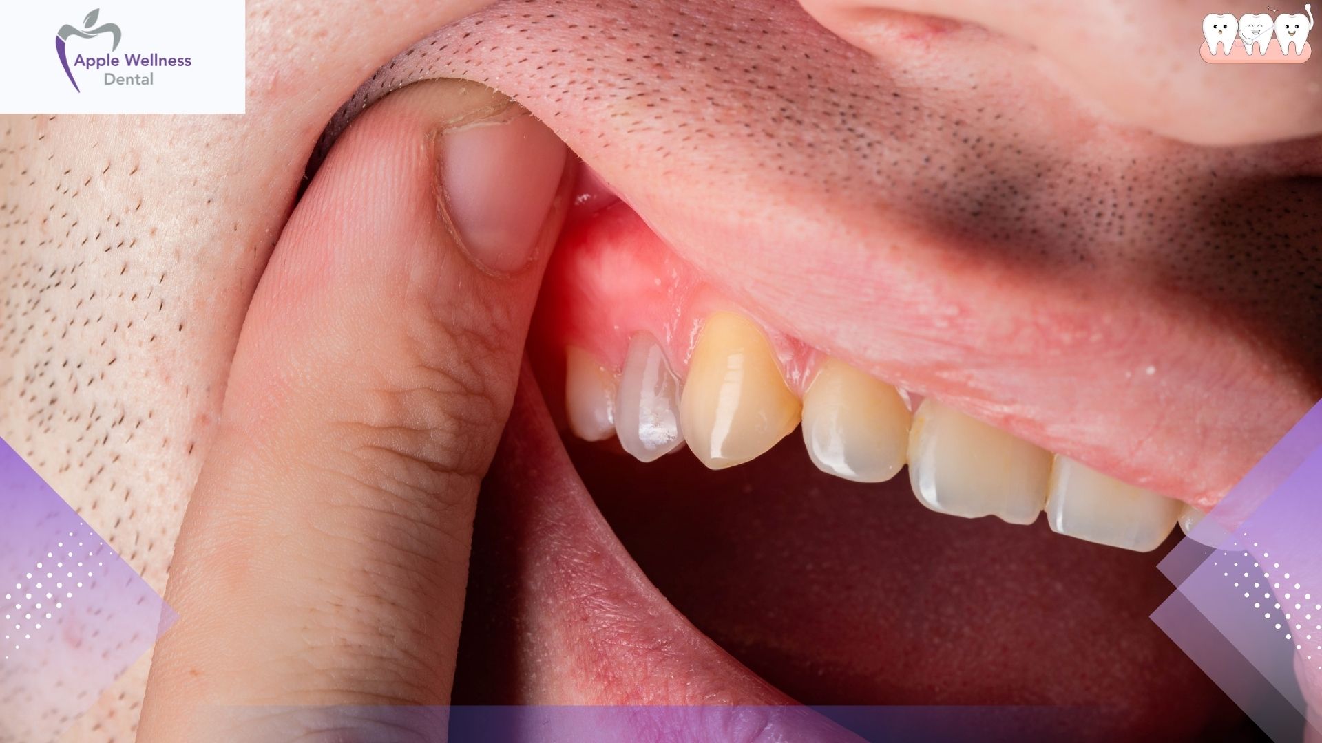 How Long Does It Take to Get Rid of Gingivitis - Apple Wellness Dental