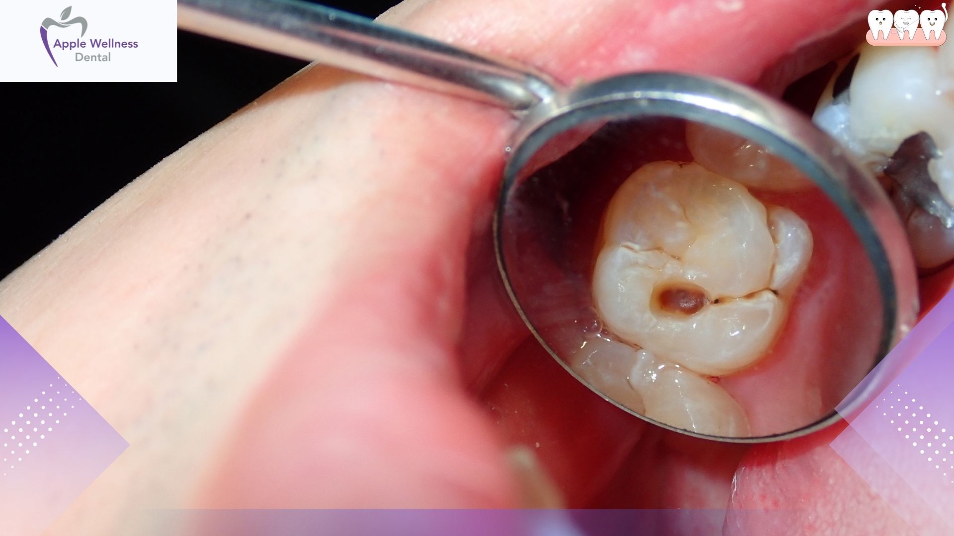 Which Is More Painful Tooth Extraction or Filling - Apple Wellness Dental
