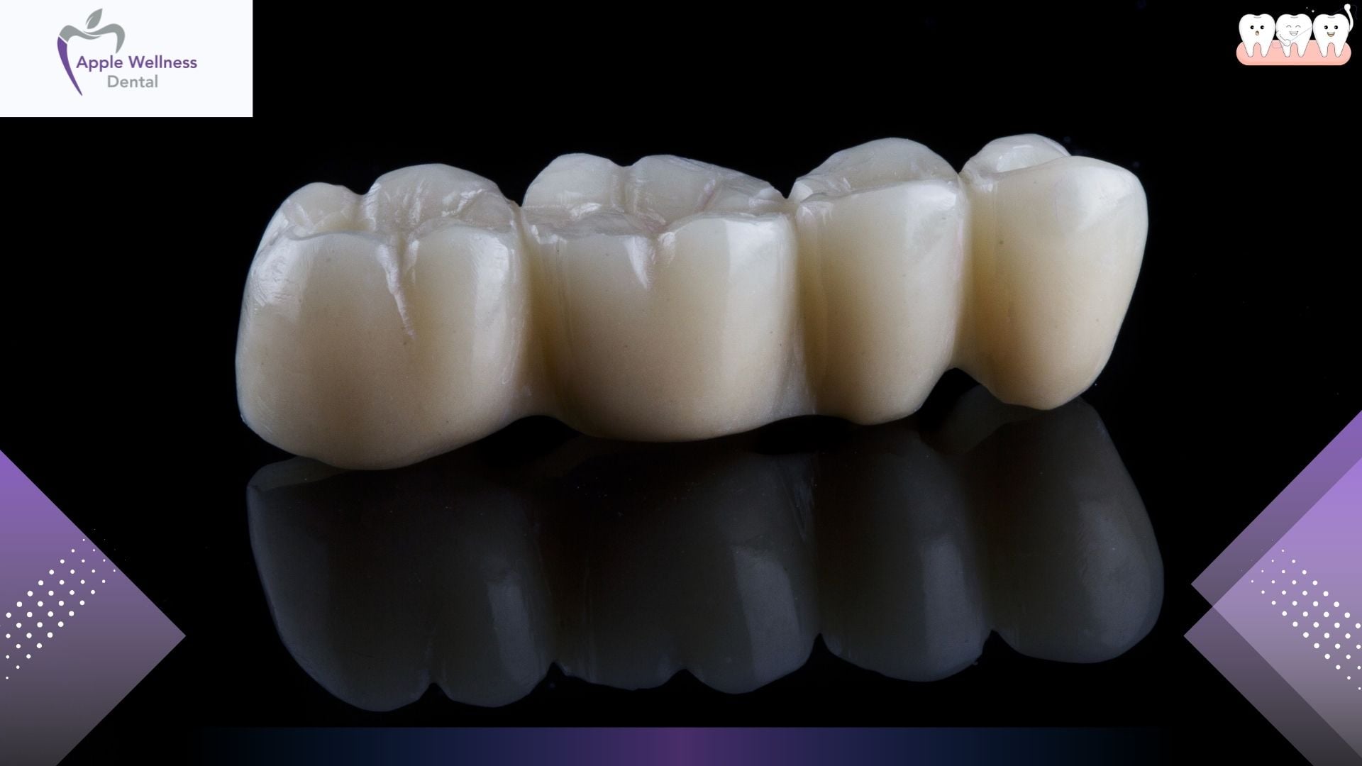 Dental Crowns and Bridges in Airdrie: Restore Your Smile at Apple Wellness Dental - Apple Wellness Dental