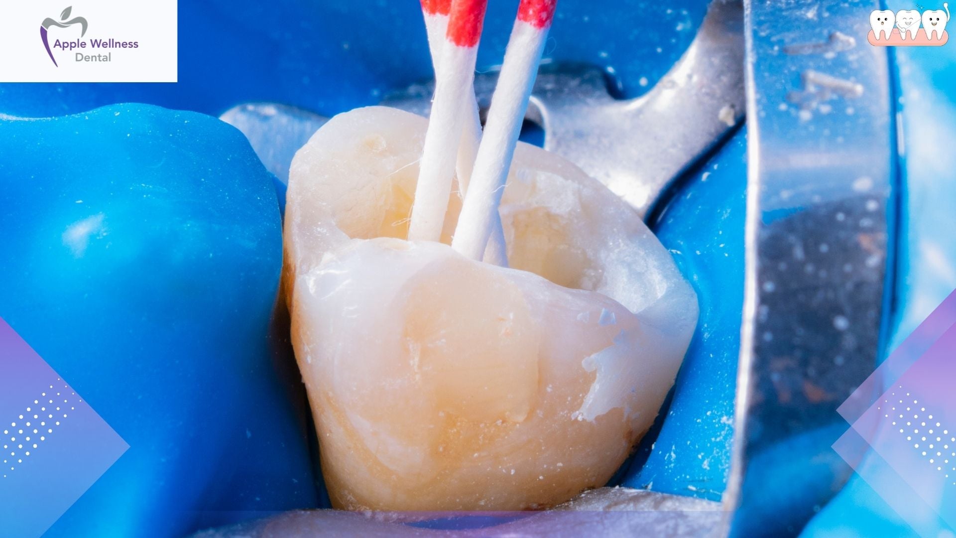 Root Canal Treatment in Airdrie, Alberta: Pain Relief and Tooth Preservation at Apple Wellness Dental - Apple Wellness Dental