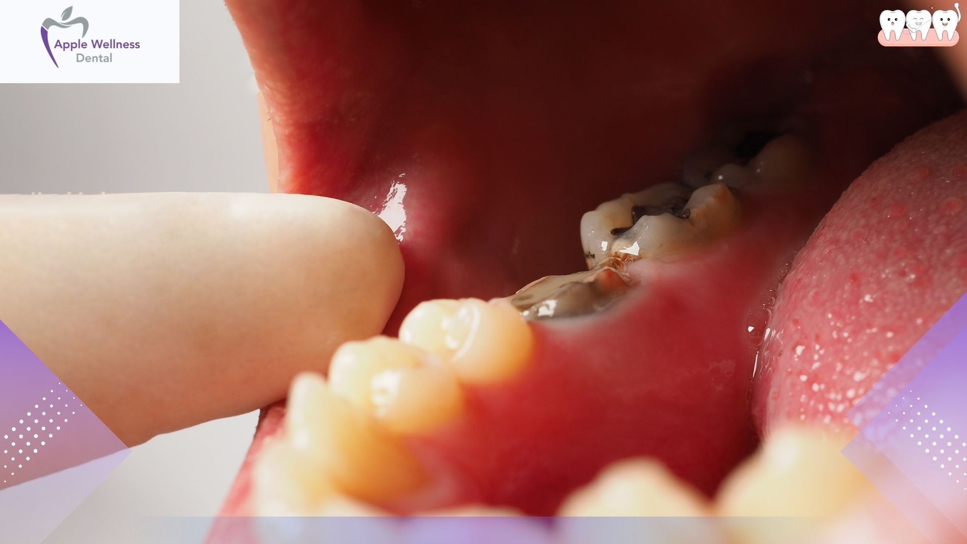 Tooth Extraction in Airdrie, Alberta: Safe, Gentle, Expert Care at Apple Wellness Dental - Apple Wellness Dental