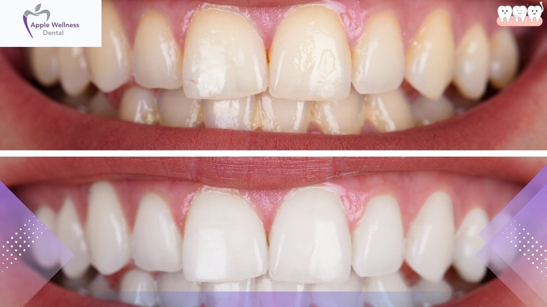 Teeth Whitening in Airdrie, Alberta: Professional Results That Last - Apple Wellness Dental