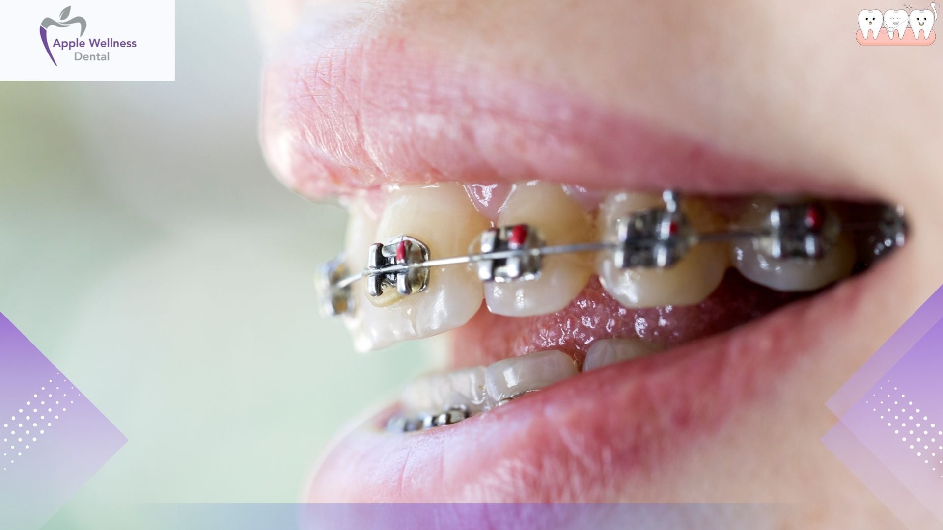 The Complete Guide to Keeping Teeth and Gums Healthy During Orthodontic Treatment - Apple Wellness Dental