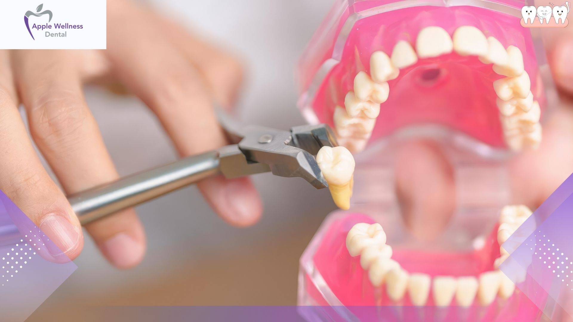 The Complete 2026 Guide to Wisdom Tooth Extraction Costs and Financial Planning - Apple Wellness Dental