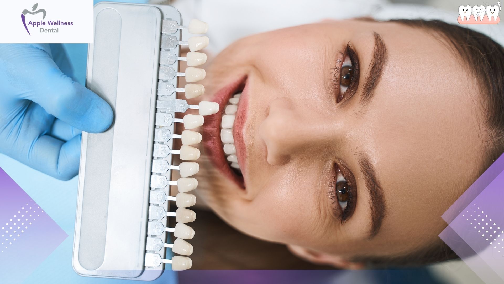Understanding the Cost of Composite Veneers: A Complete Guide for 2026 - Apple Wellness Dental