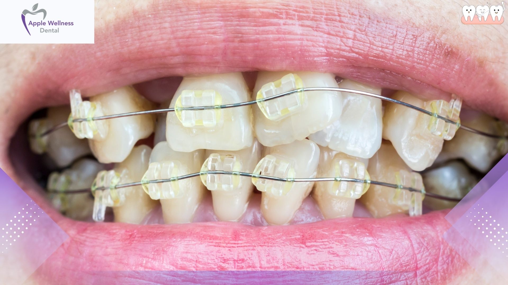Transforming Your Smile: Can Dental Veneers Correct Crooked Teeth? - Apple Wellness Dental