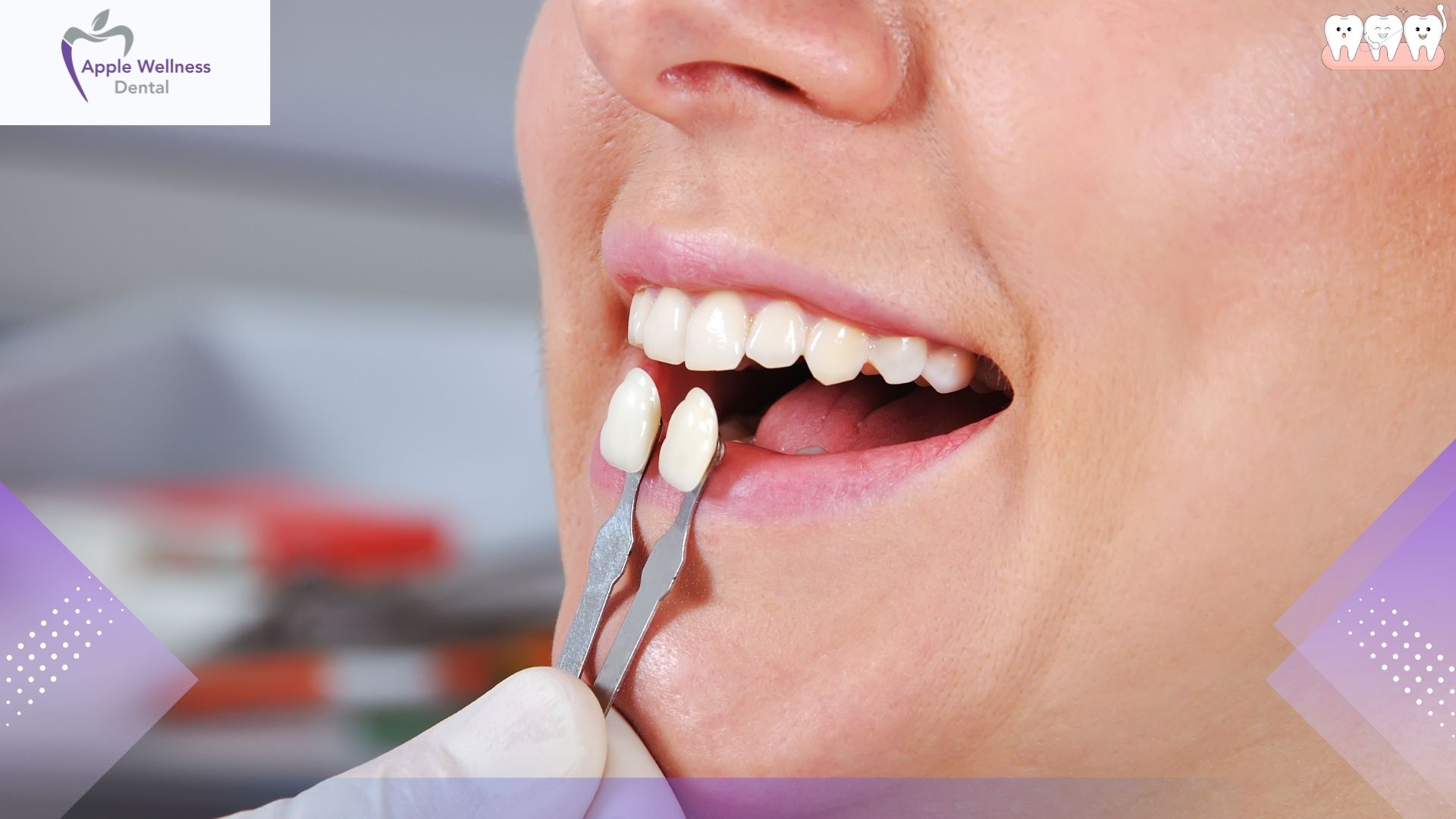 The Complete Guide to Veneer Lifespans: Durability, Care, and Replacement in 2026 - Apple Wellness Dental