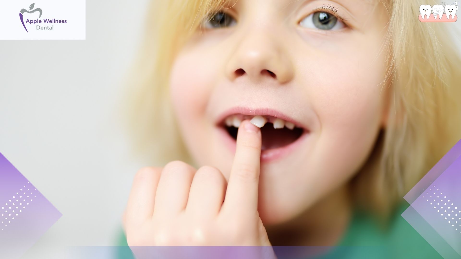 Understanding Tooth Gaps: Causes, Clinical Concerns, and Treatment Options - Apple Wellness Dental