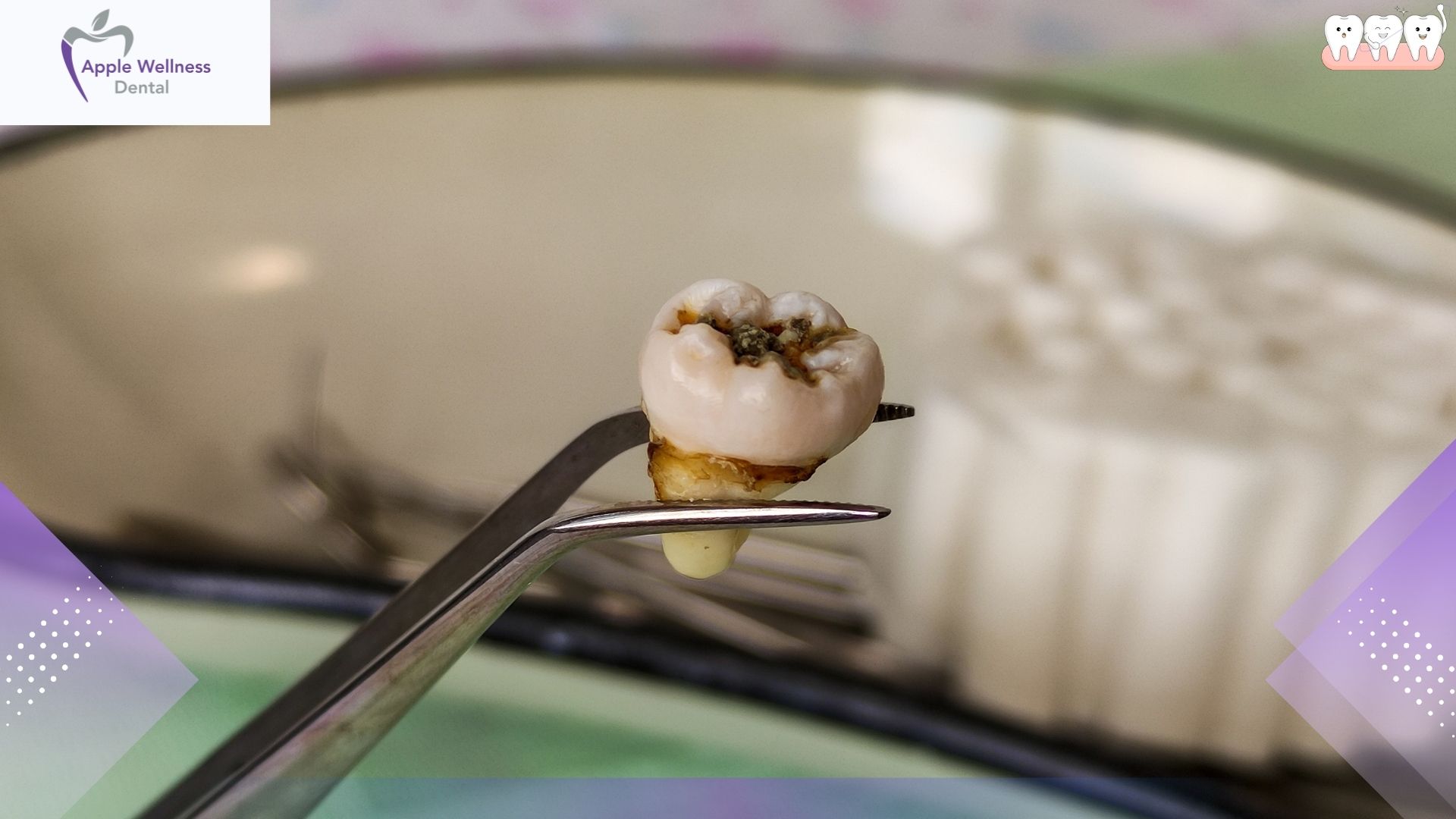 The Complete Guide to Managing Bleeding After Wisdom Tooth Removal - Apple Wellness Dental