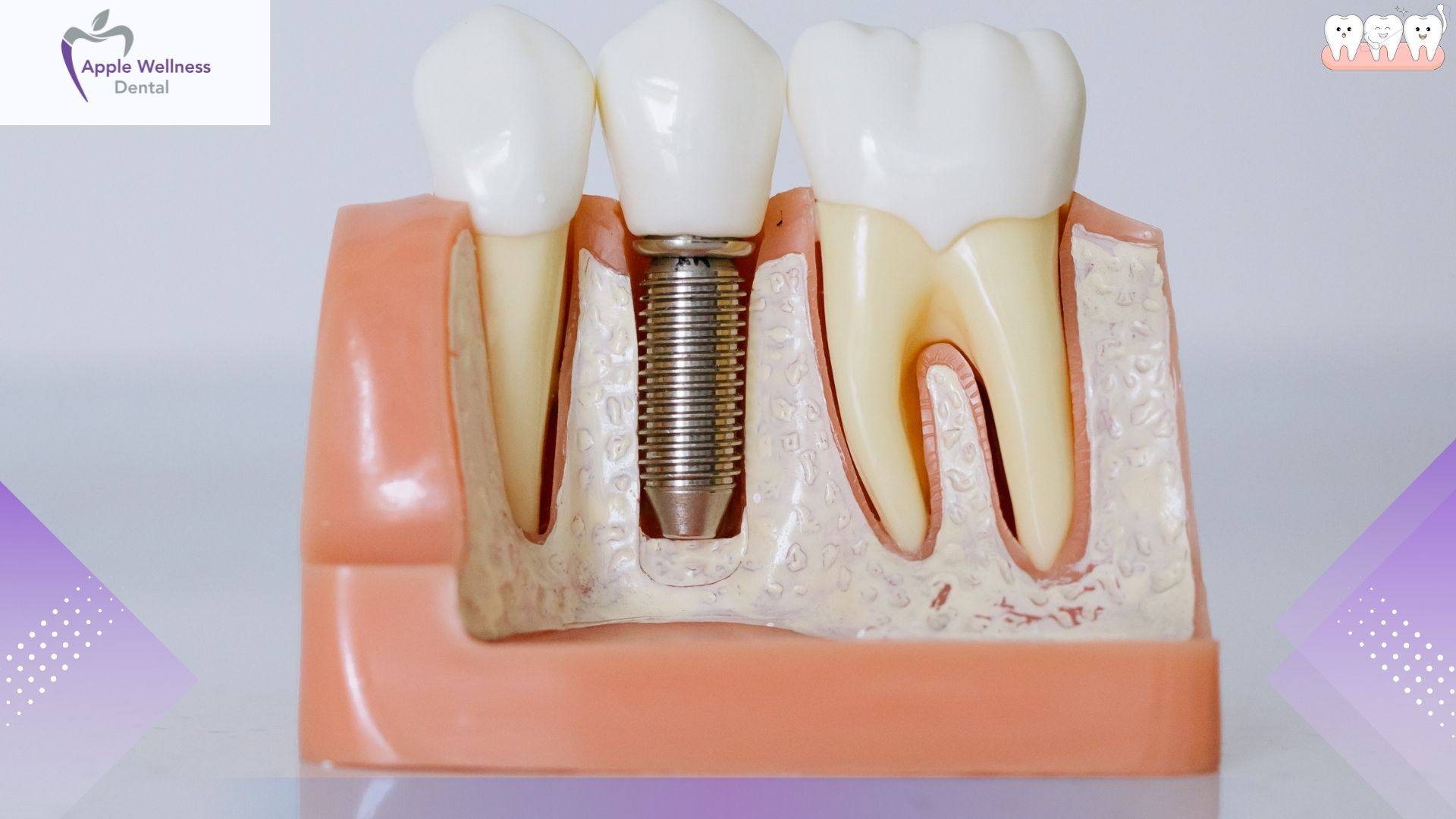 What a Healing Tooth Extraction Site Looks Like: The Complete 2026 Recovery Guide - Apple Wellness Dental