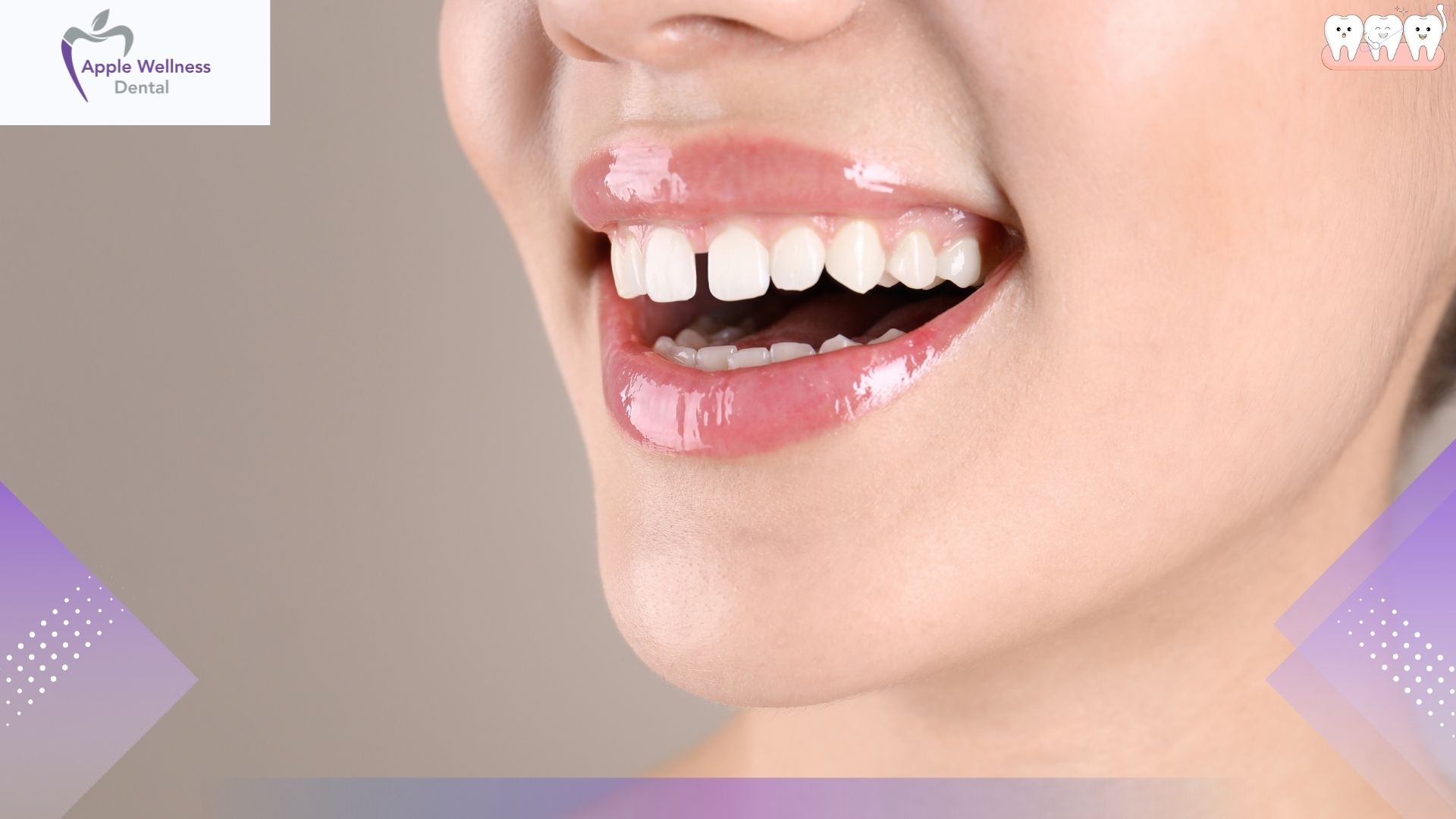 Understanding Tooth Gaps: Causes, Clinical Concerns, and Treatment Options - Apple Wellness Dental