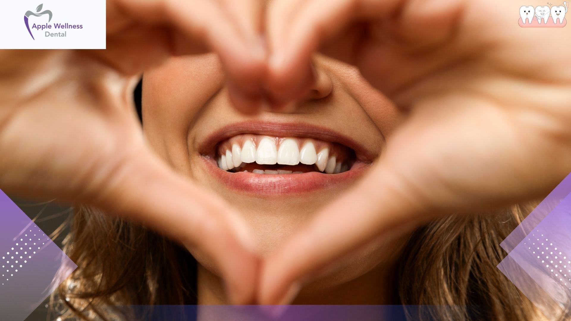 Protecting Your Smile: The Truth About Tooth Decay Under Dental Veneers - Apple Wellness Dental