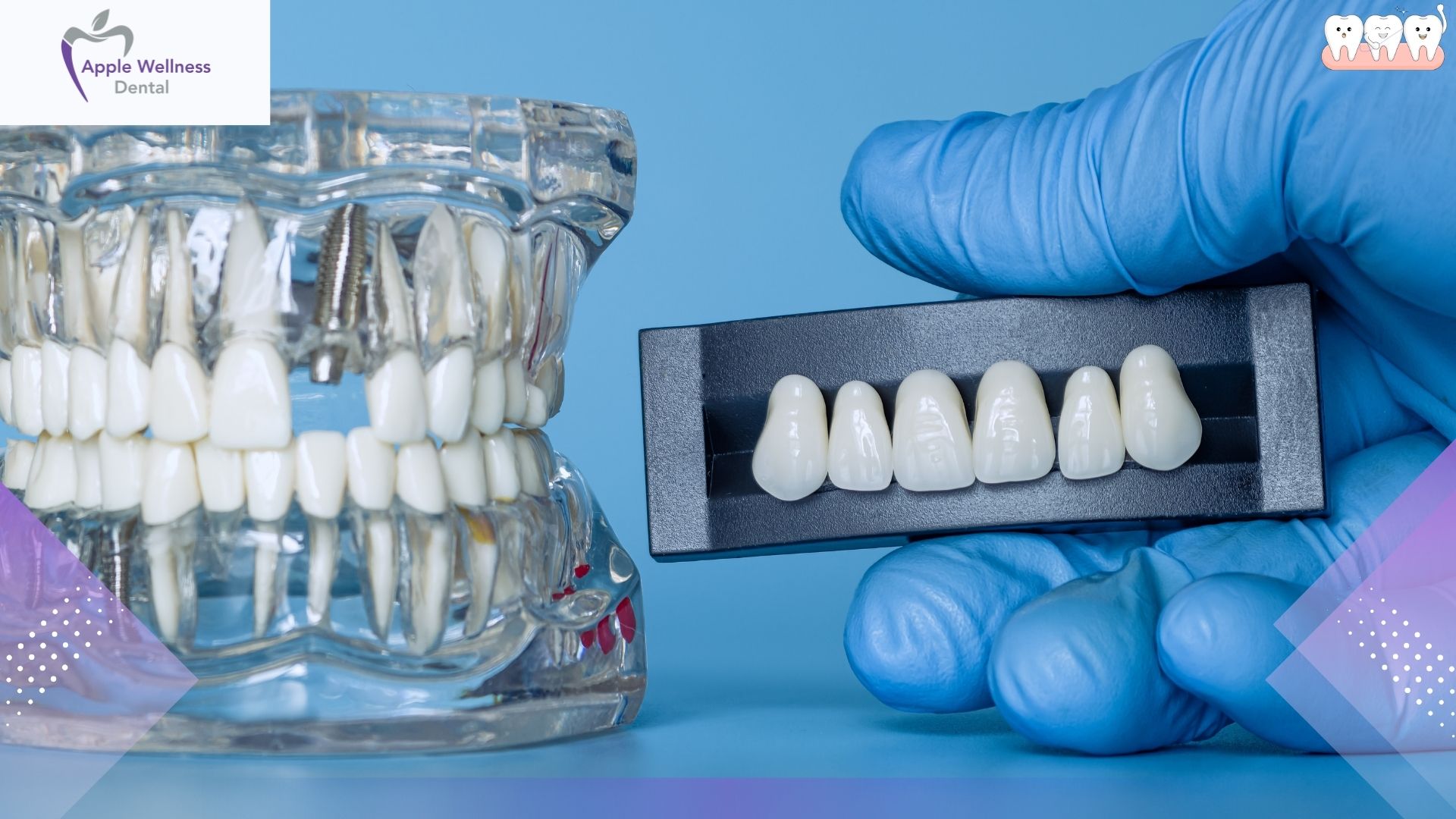 The Complete Guide to the Porcelain Manufacturing Process: From Raw Clay to Fired Masterpiece - Apple Wellness Dental