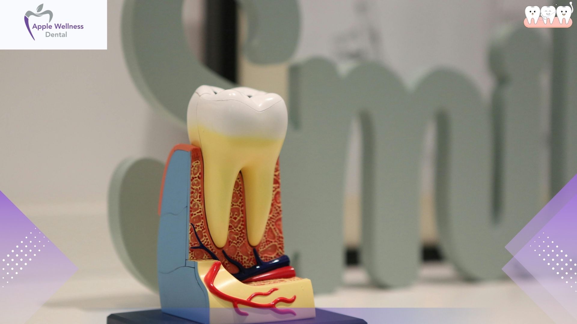 The Definitive 2026 Guide: Returning to a Solid Diet After Wisdom Tooth Extraction - Apple Wellness Dental