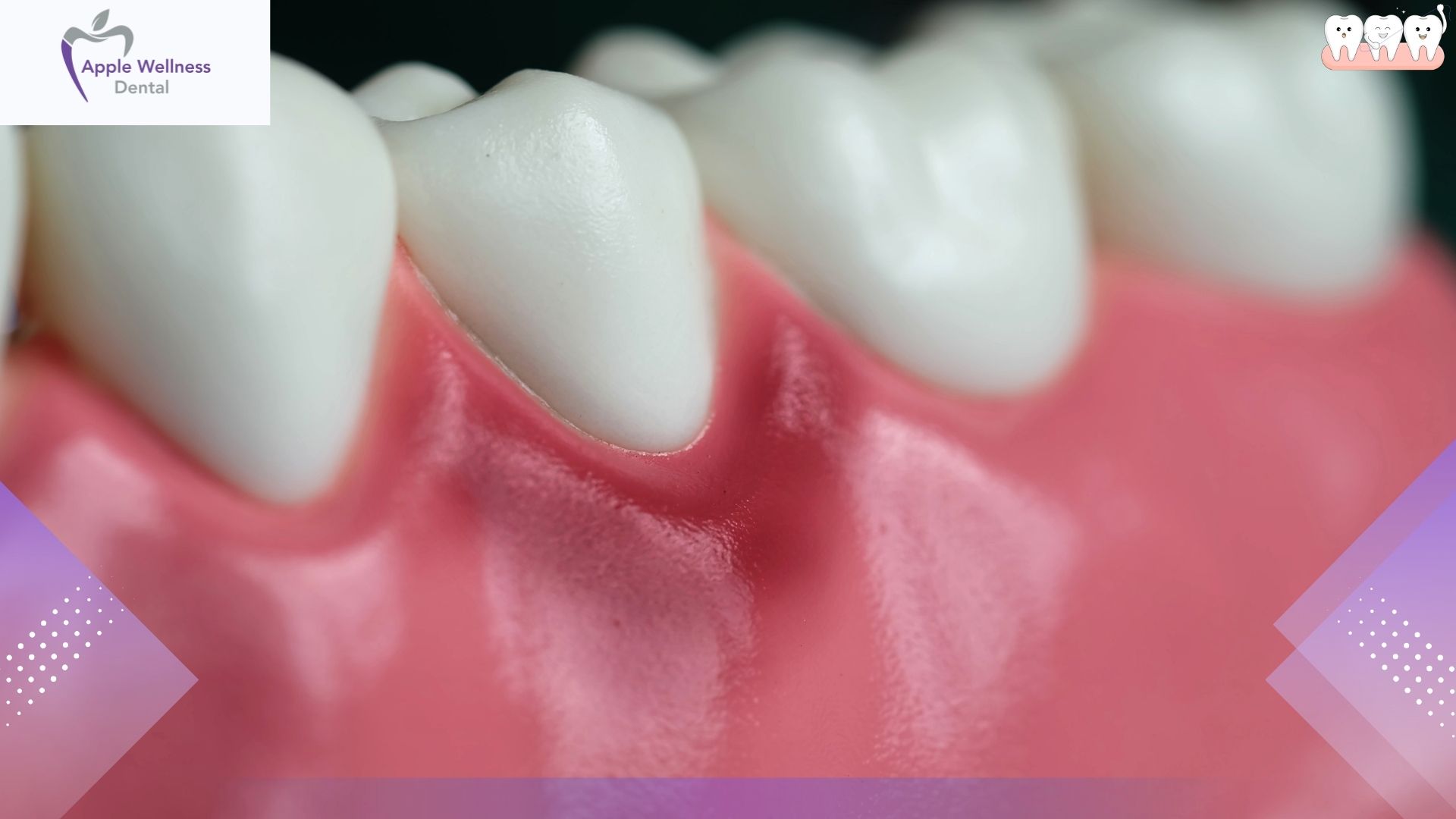 The Complete Guide to Detecting Early Signs of Gum Disease Before It Advances - Apple Wellness Dental