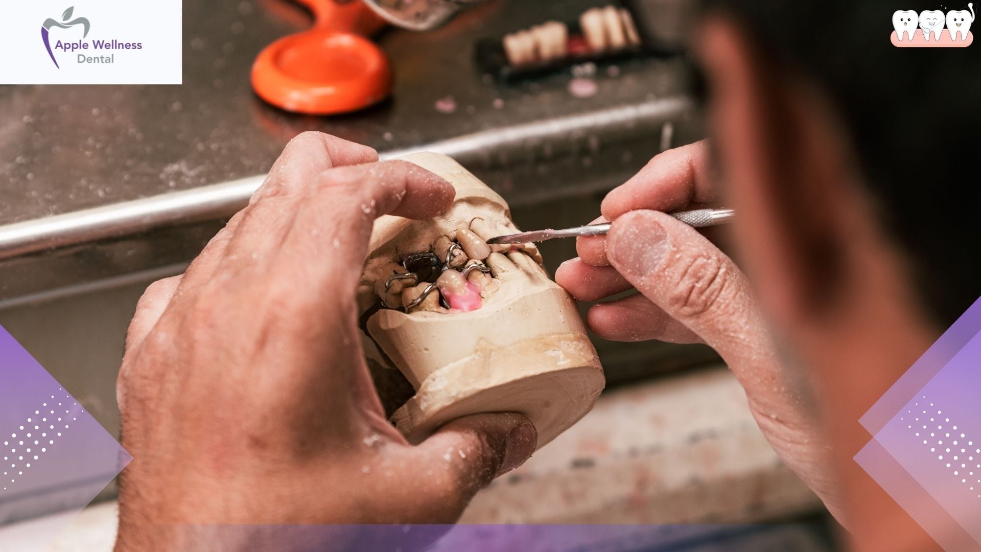 The Complete Guide to Fixed Dental Prostheses: Restoring Function and Aesthetics - Apple Wellness Dental