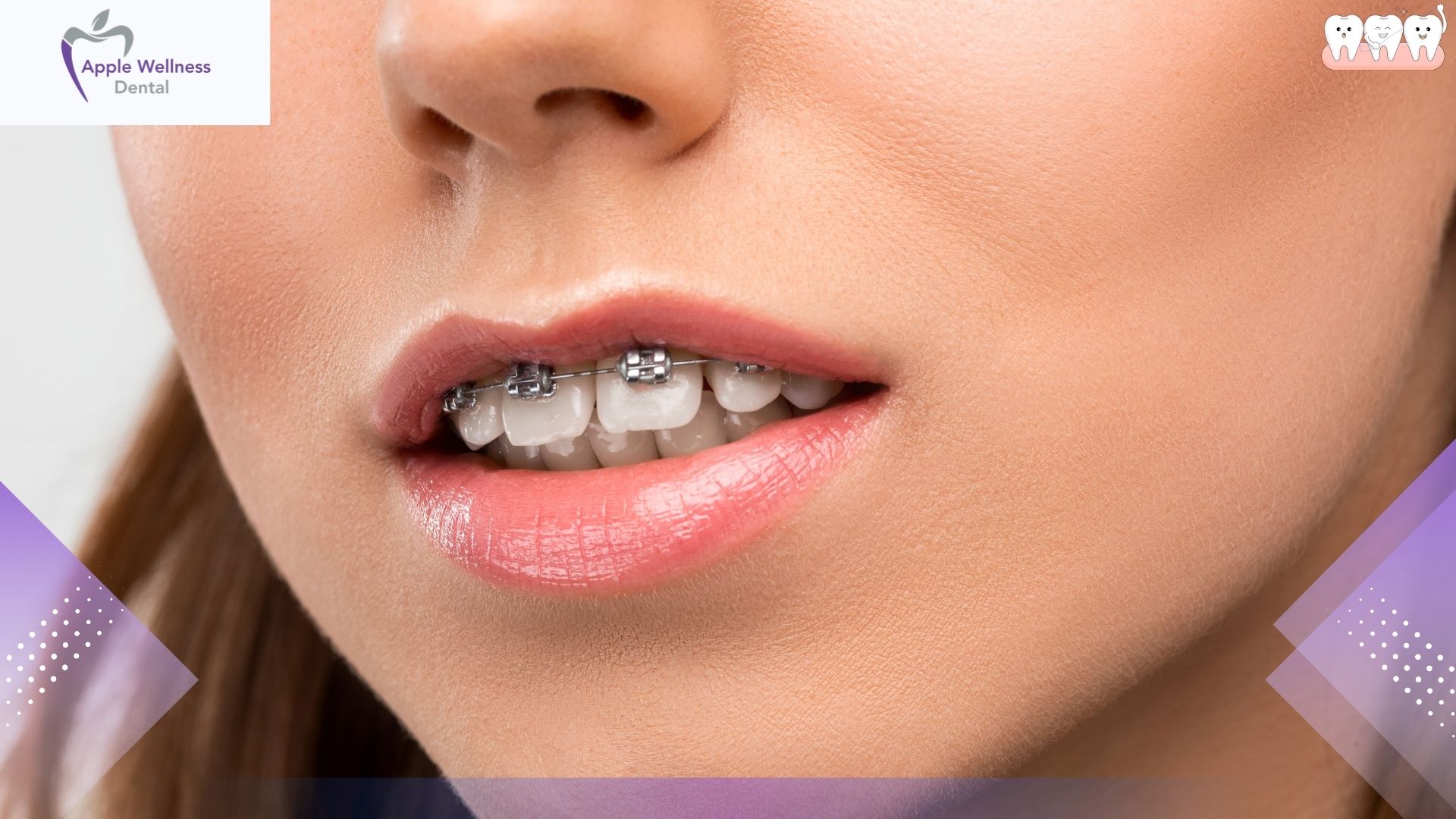 Transforming Your Smile: Can Dental Veneers Correct Crooked Teeth? - Apple Wellness Dental