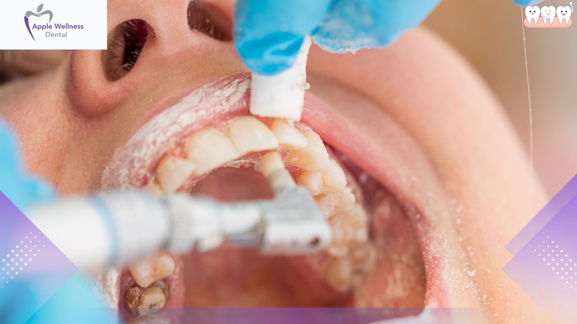 The Ultimate 2026 Guide to Mastering Your Water Flosser for Optimal Oral Health - Apple Wellness Dental