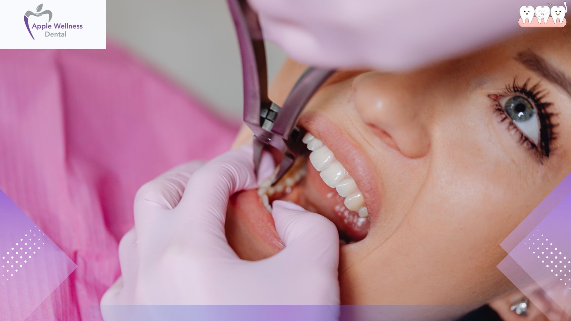 The Reality of Tooth Extraction Pain: A Comprehensive Guide to Procedure and Recovery - Apple Wellness Dental