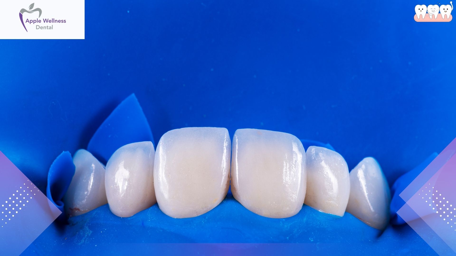 The Complete Guide to Cosmetic Dental Restorations: Understanding Veneer Lifespans in 2026 - Apple Wellness Dental The Complete Guide to Cosmetic Dental Restorations: Understanding Veneer Lifespans in 2026 - Apple Wellness Dental