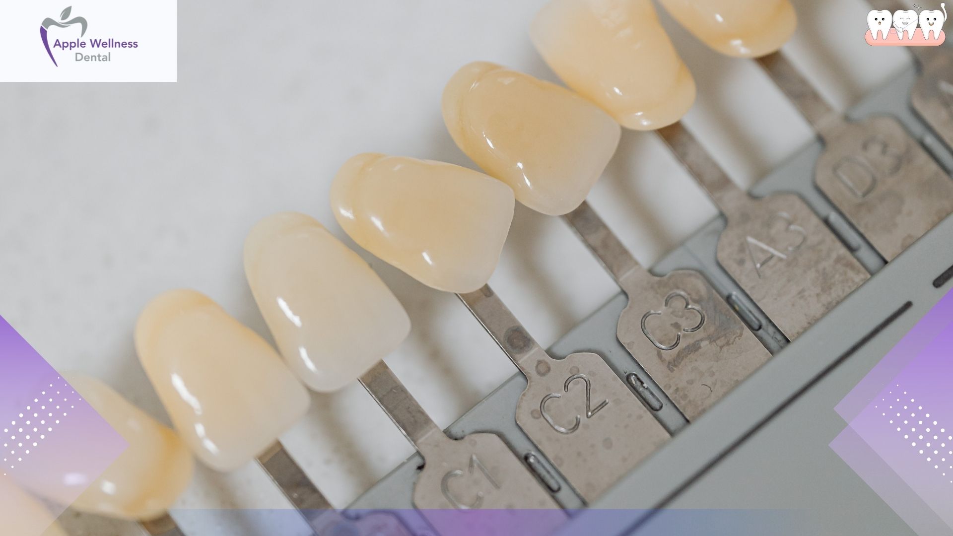 The Complete 2026 Guide to Dental Veneer Pricing: What to Expect Before You Commit - Apple Wellness Dental