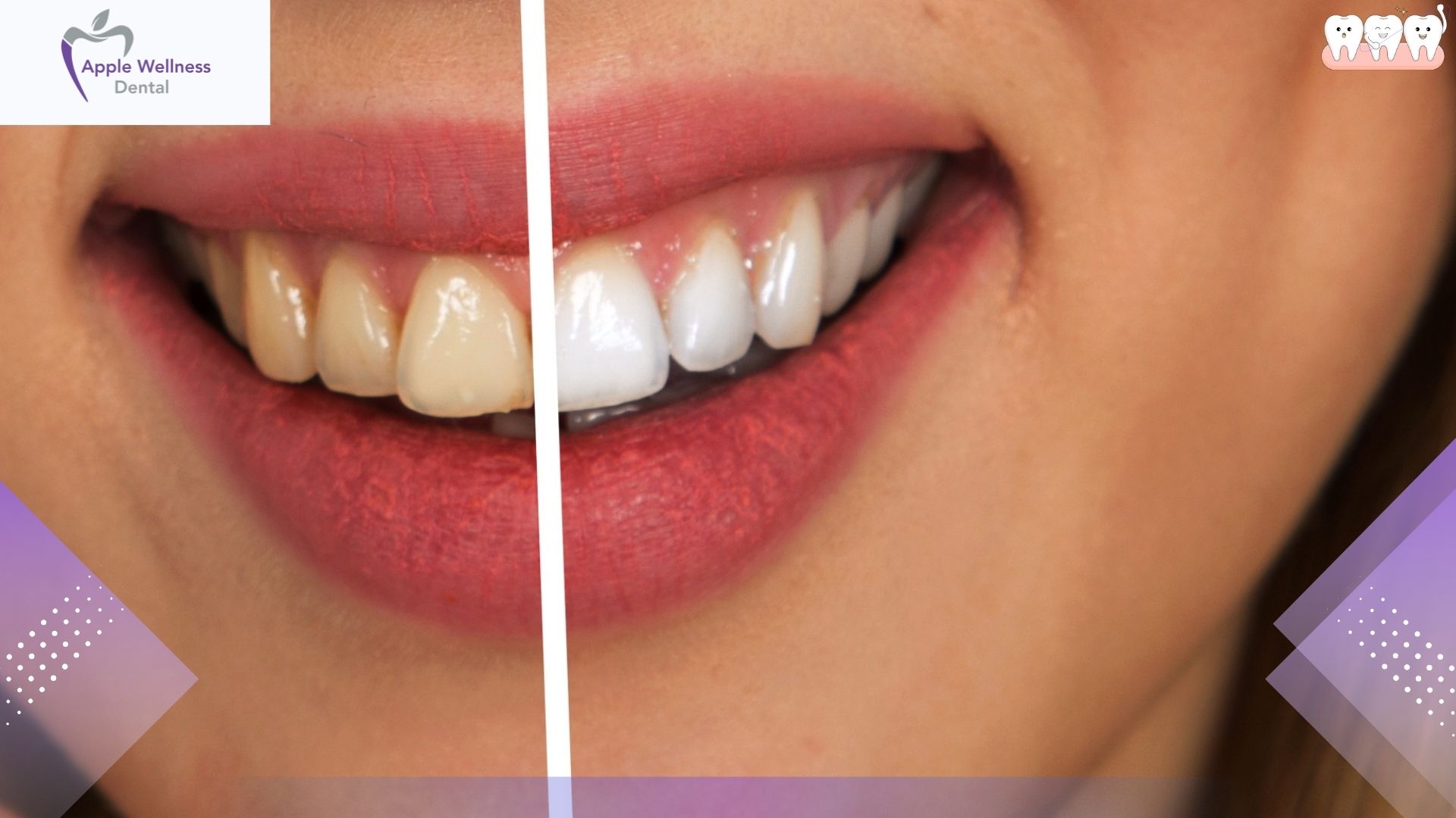 The Complete Guide to Resuming a Regular Diet Post-Extraction - Apple Wellness Dental The Complete Guide to Resuming a Regular Diet Post-Extraction - Apple Wellness Dental
