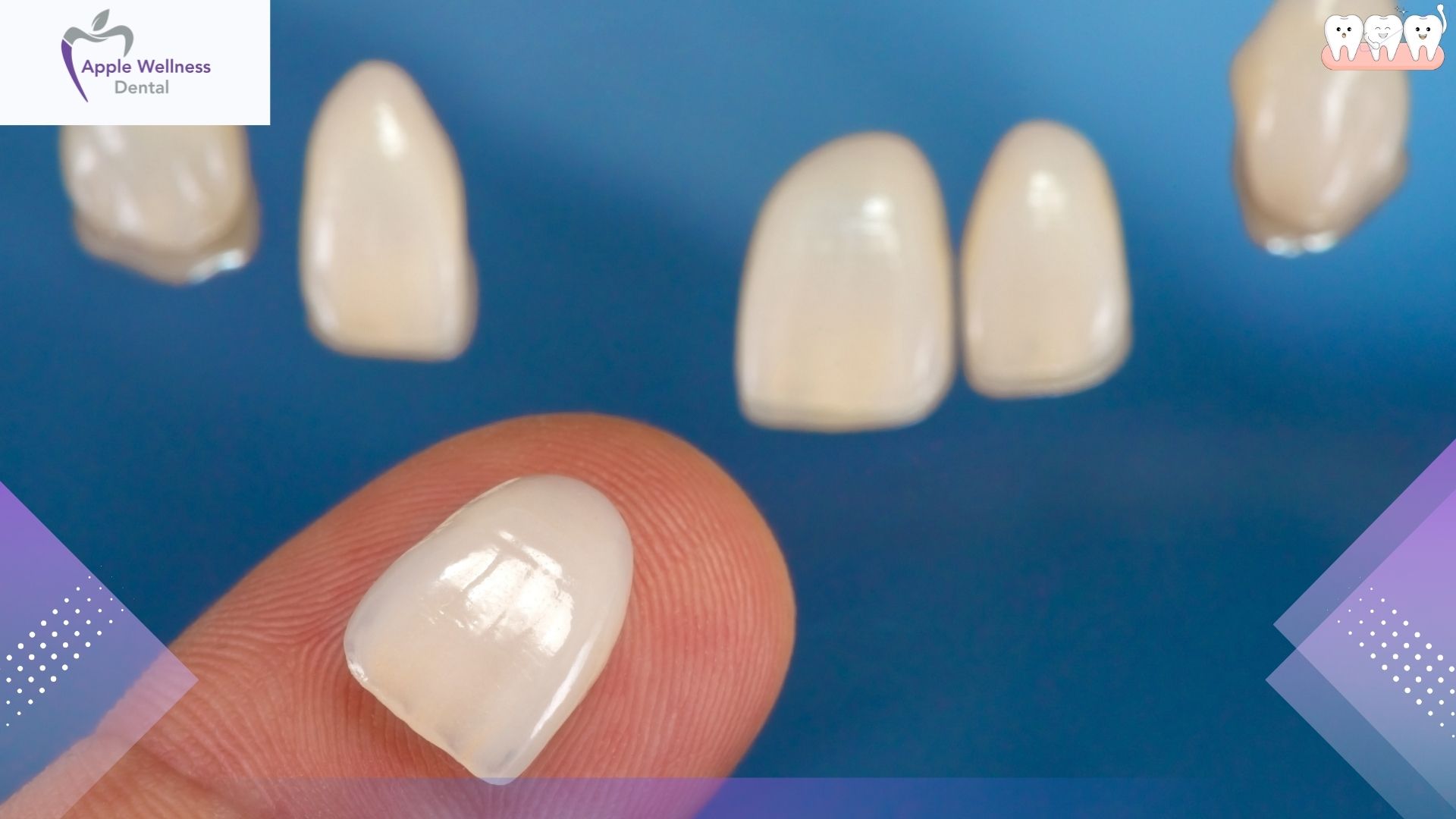 The Complete Guide to Cosmetic Dental Restorations: Understanding Veneer Lifespans in 2026 - Apple Wellness Dental The Complete Guide to Cosmetic Dental Restorations: Understanding Veneer Lifespans in 2026 - Apple Wellness Dental