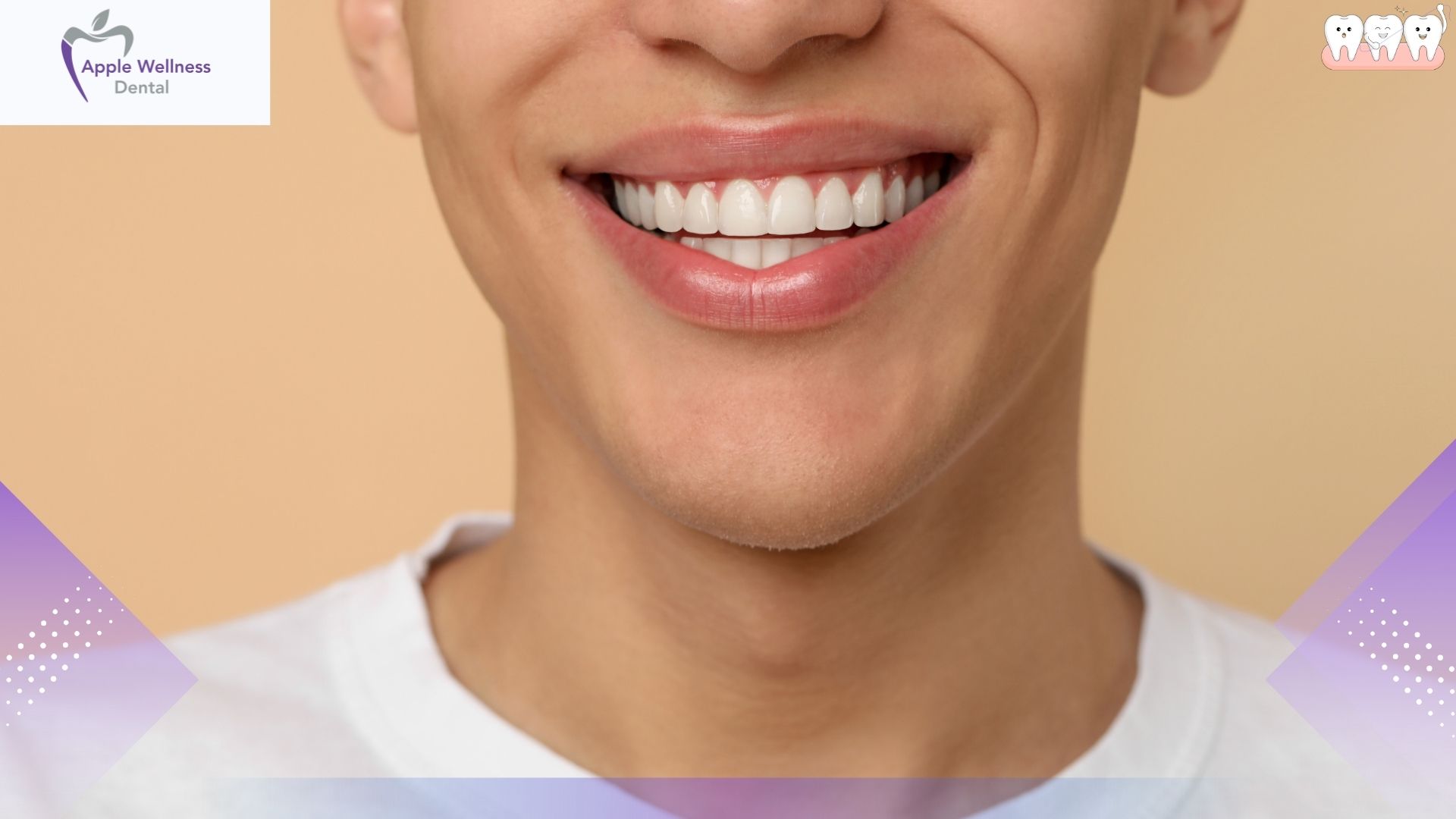 The Comprehensive 2026 Guide to Dental Veneer Costs, Materials, and Procedures - Apple Wellness Dental