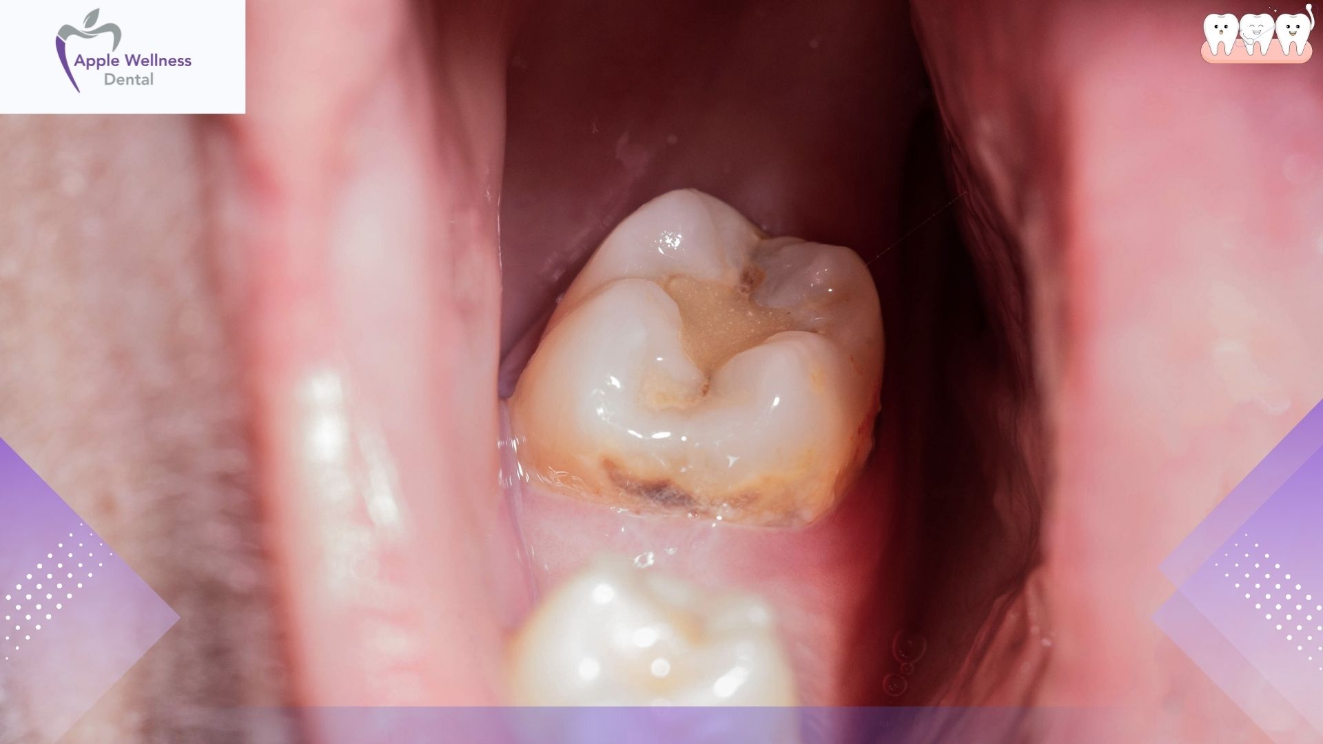 The Complete 2026 Recovery Guide: When Is It Safe to Consume Alcohol After Getting a Tooth Pulled? - Apple Wellness Dental