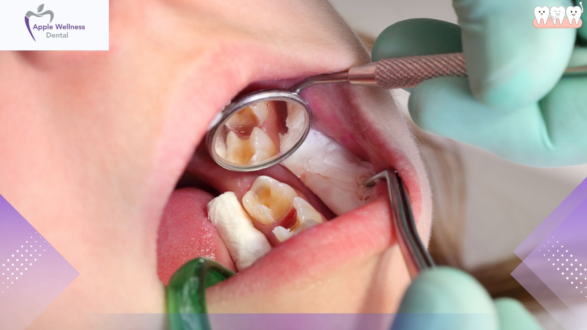 The Comprehensive 2026 Guide: Safe Timelines for Drinking After Dental Extractions - Apple Wellness Dental