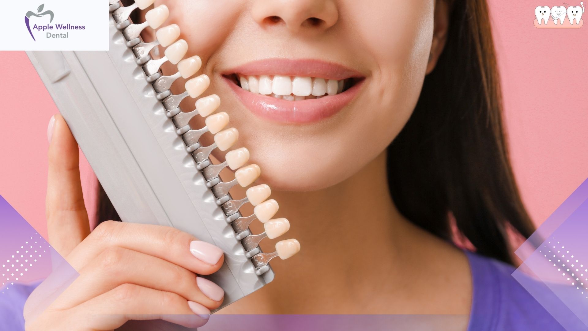 The Ultimate 2026 Guide to the Lifespan and Durability of Composite Veneers - Apple Wellness Dental