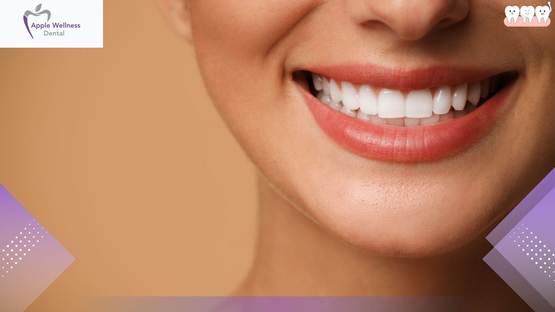 The Comprehensive 2026 Guide to Dental Veneer Costs, Materials, and Procedures - Apple Wellness Dental