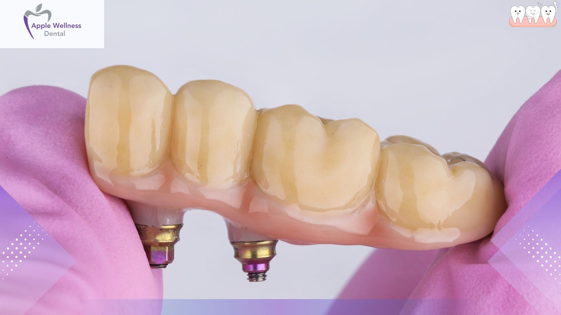 The Ultimate 2026 Guide to Dental Bridge Costs and Treatment Options - Apple Wellness Dental