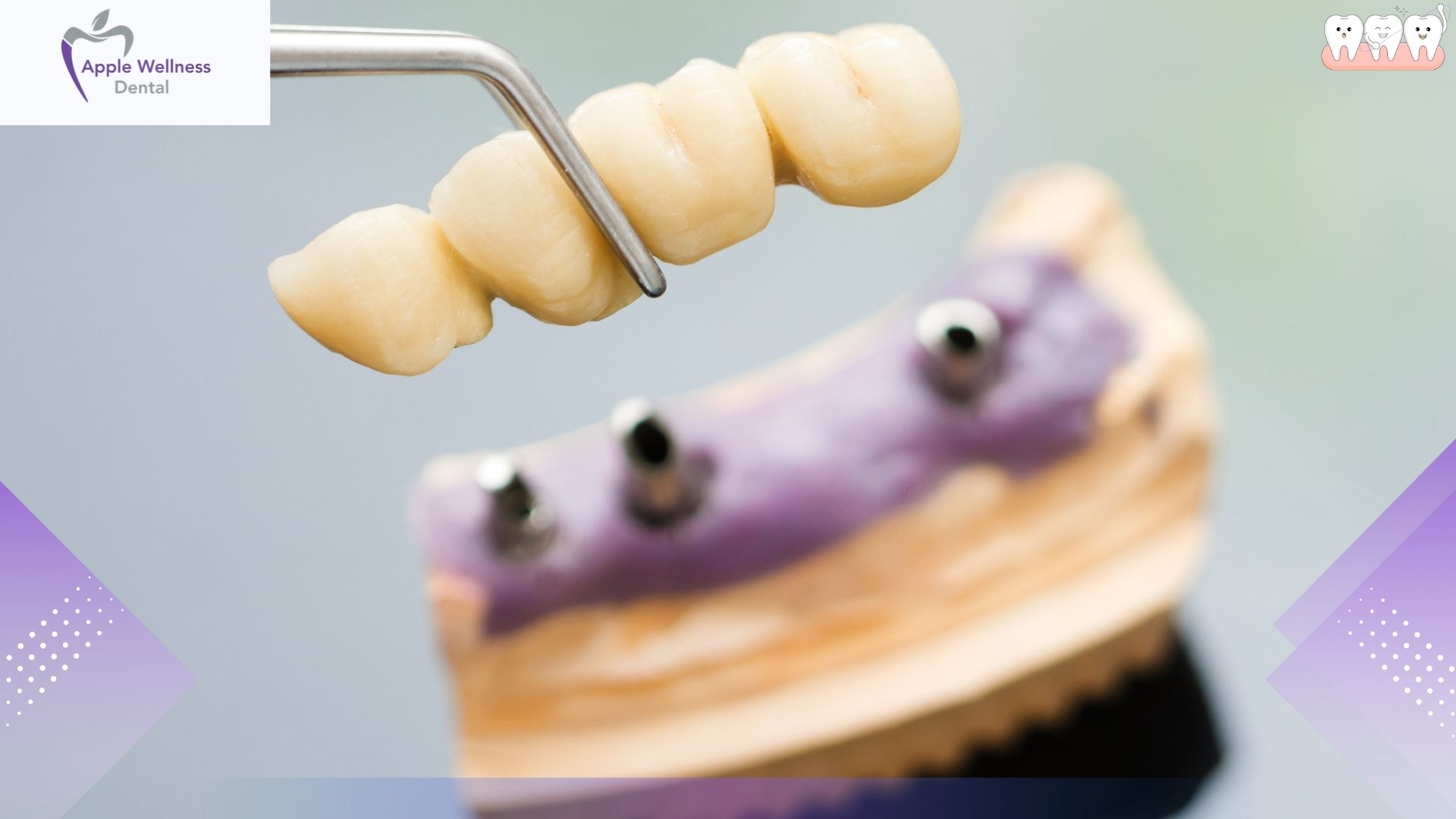 The Ultimate 2026 Guide to Dental Bridge Costs and Treatment Options - Apple Wellness Dental