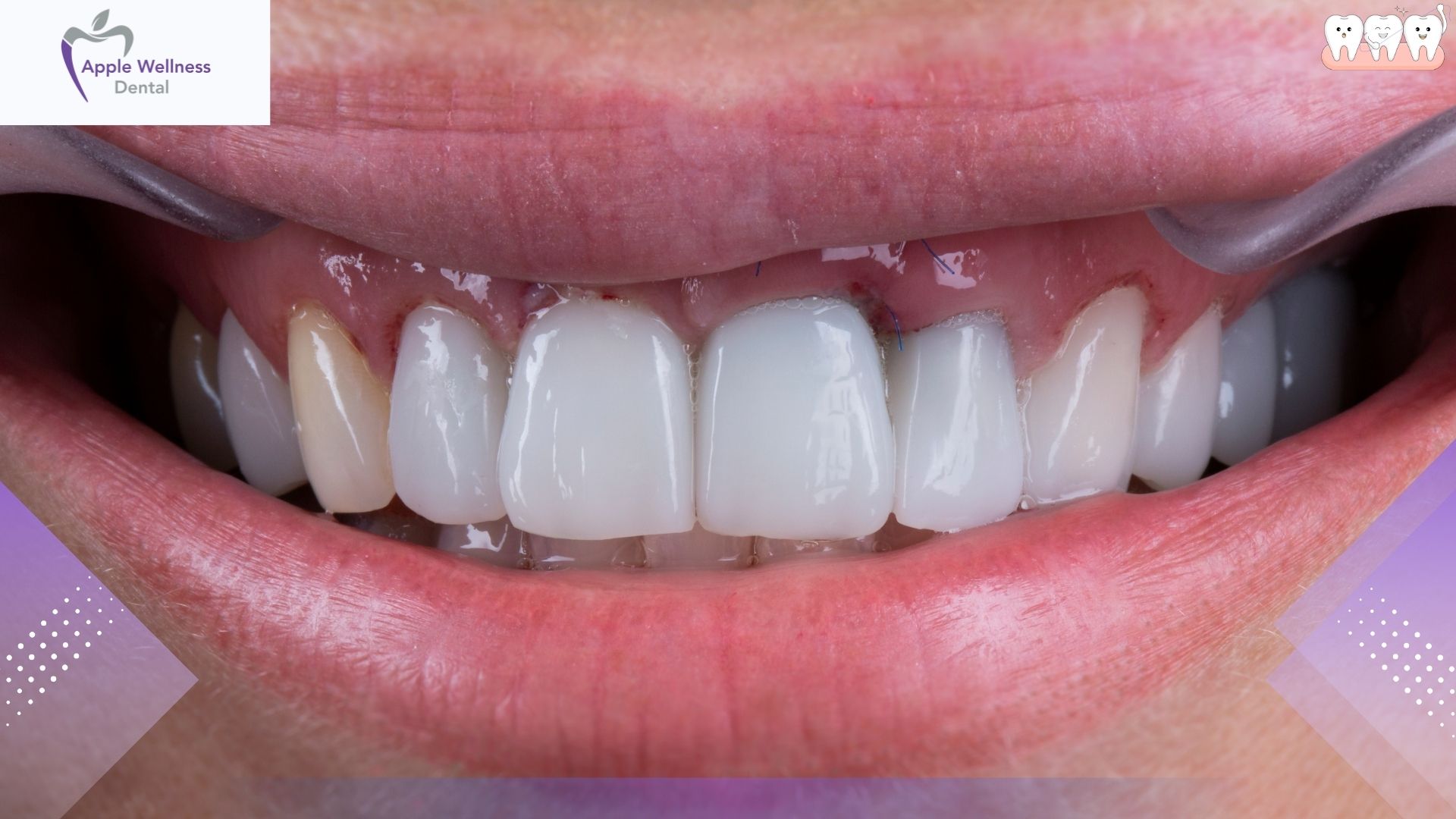 The Complete 2026 Guide to Porcelain Crown Costs and Insurance Coverage - Apple Wellness Dental