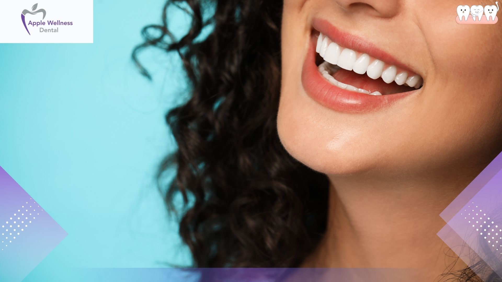 The Ultimate 2026 Guide to the Lifespan and Durability of Composite Veneers - Apple Wellness Dental
