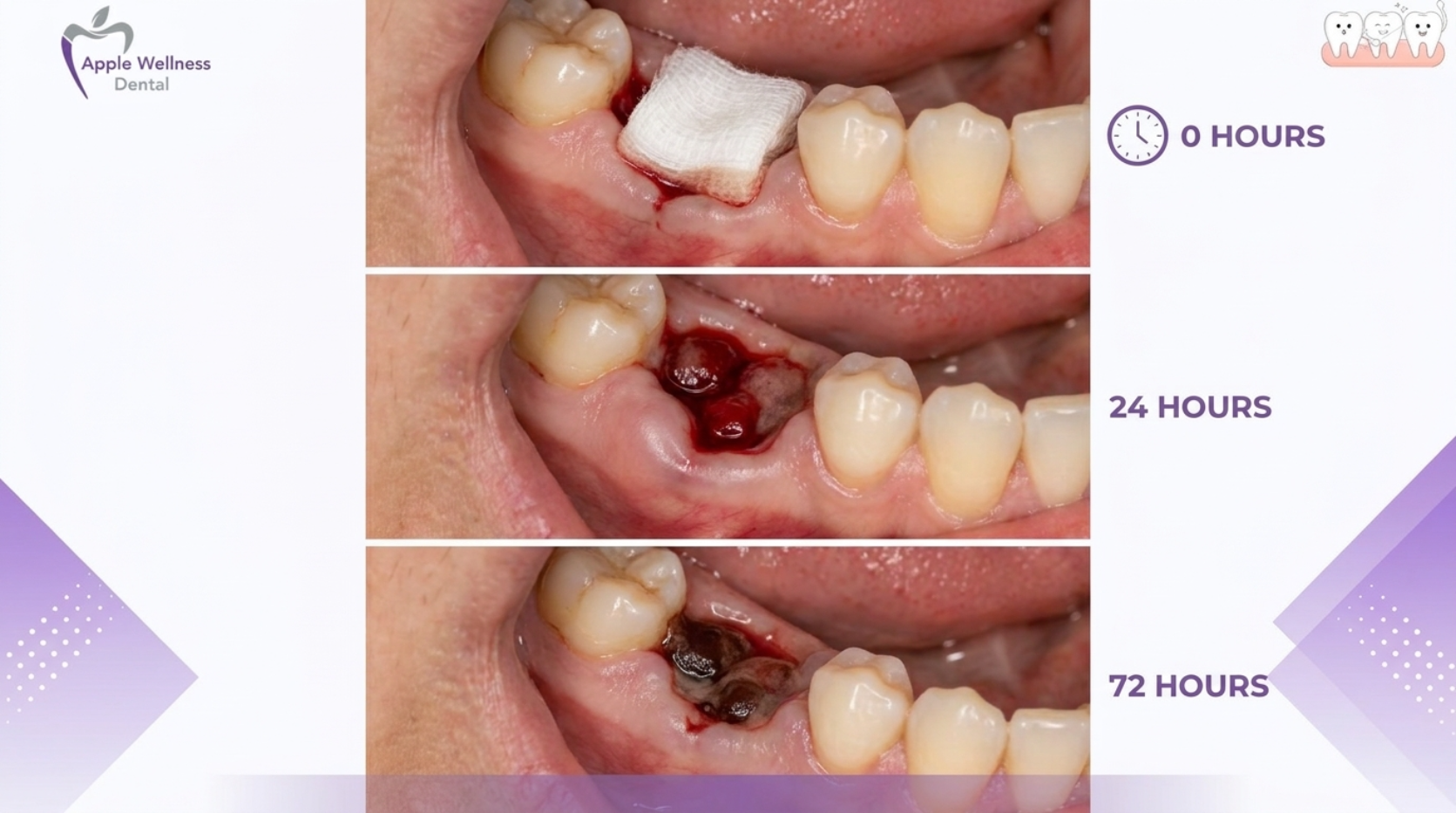 The Complete Post-Operative Guide to Drinking Coffee After Tooth Extraction - Apple Wellness Dental The Complete Post-Operative Guide to Drinking Coffee After Tooth Extraction - Apple Wellness Dental