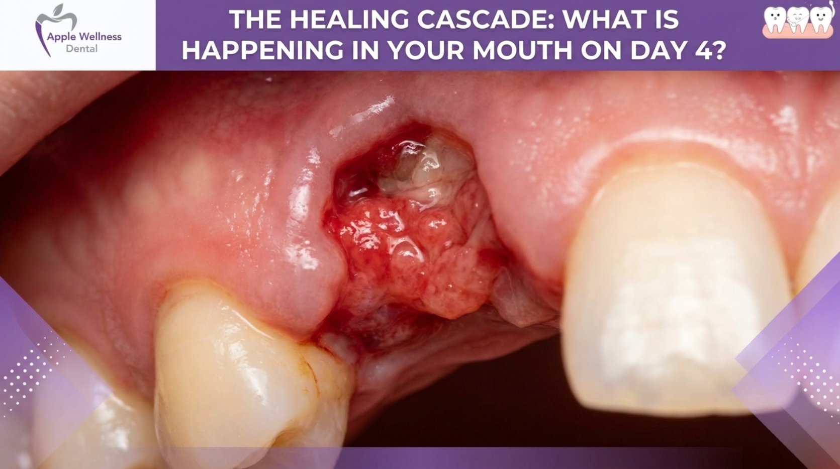 Healing Safely: The Complete Guide to Smoking After Tooth Extraction - Apple Wellness Dental
