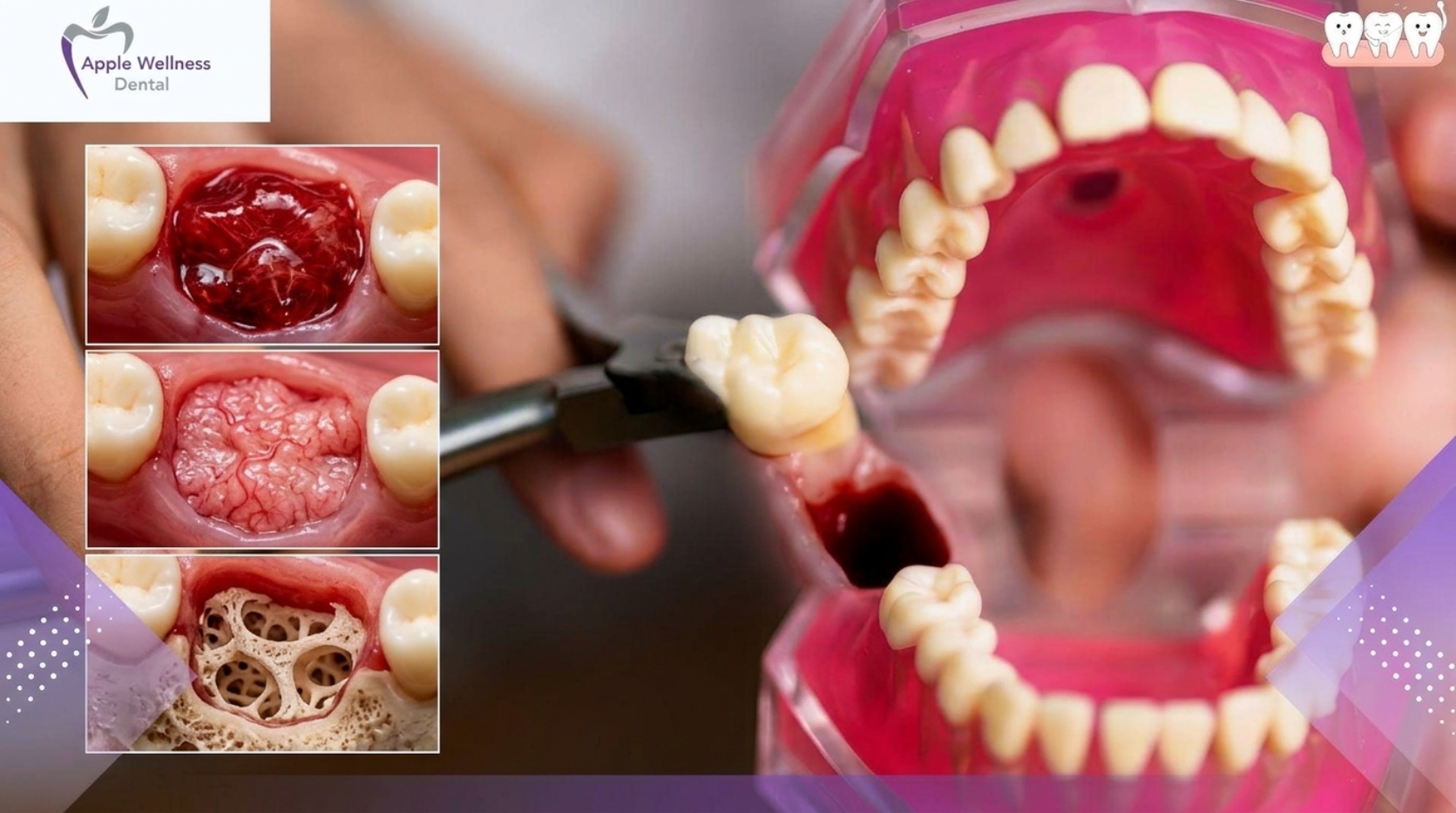 The Complete 2026 Guide: Healing Timelines and Post-Extraction Care - Apple Wellness Dental