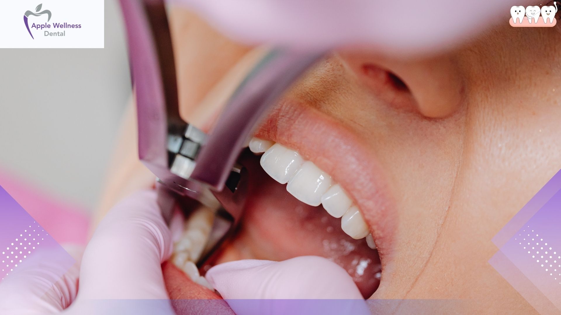 The Ultimate 2026 Guide on Safely Brushing Your Teeth Post-Extraction - Apple Wellness Dental The Ultimate 2026 Guide on Safely Brushing Your Teeth Post-Extraction - Apple Wellness Dental